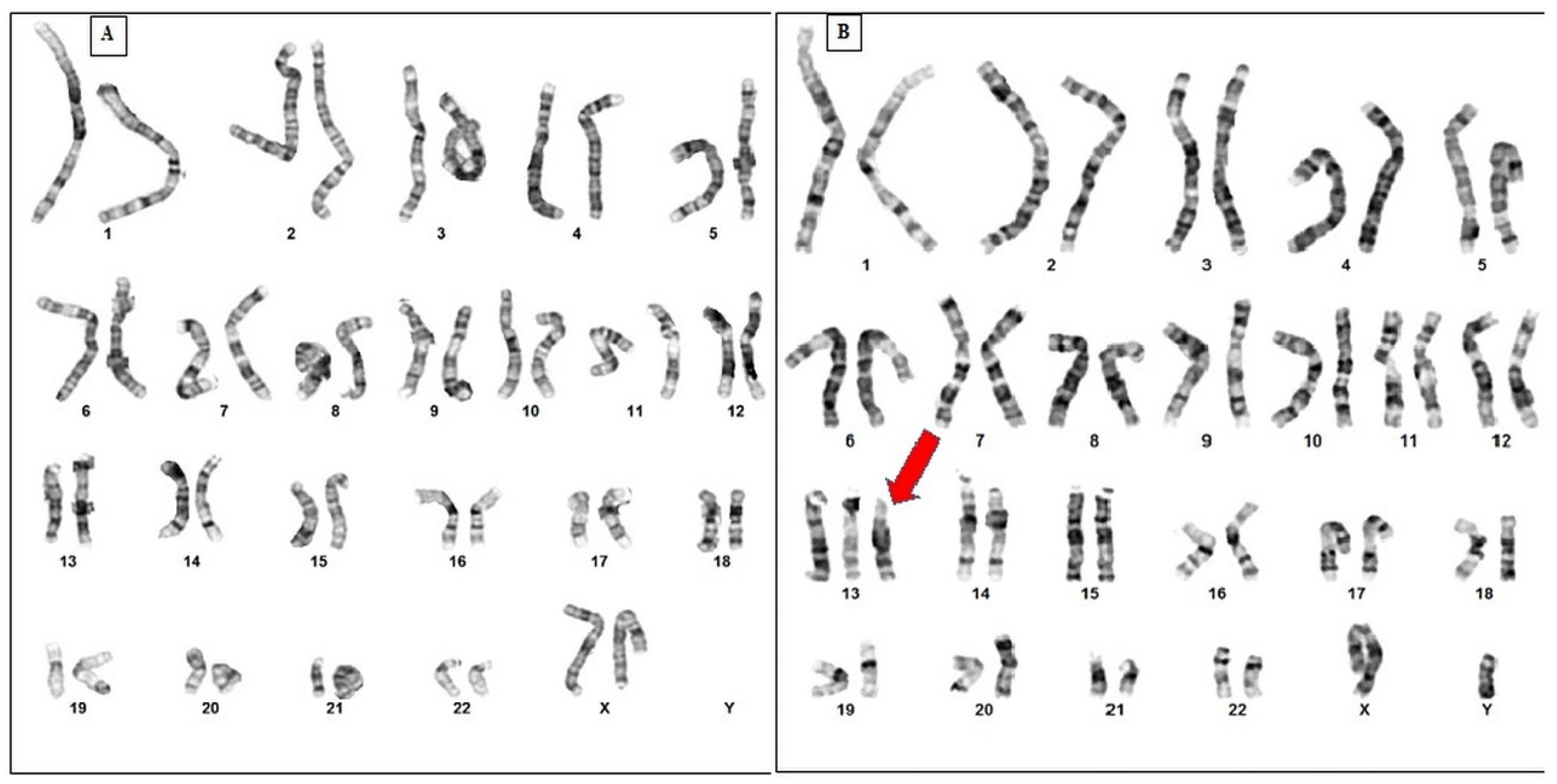 PDF) Case Report of Ring Chromosome 13: 46,XX,r(13)(p13q34)/46,XX,dic r(13; 13)(p13q34;p13q34)