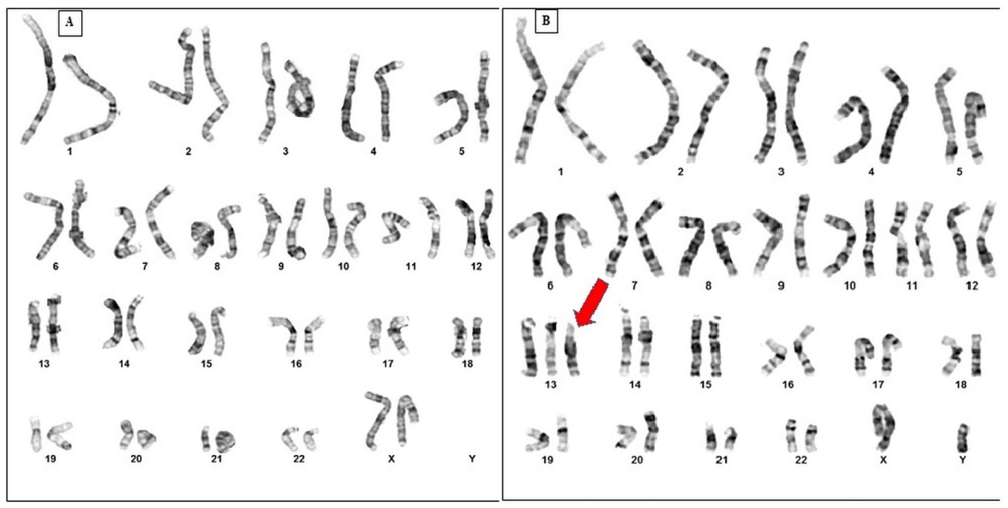 Cytogenetic evaluation of primary amenorrhea: a study of 100 cases at  tertiary centre | Egyptian Journal of Medical Human Genetics | Full Text