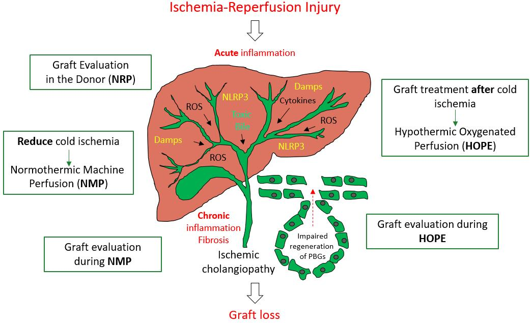 IJMS Free FullText Impact of Machine Perfusion on Biliary