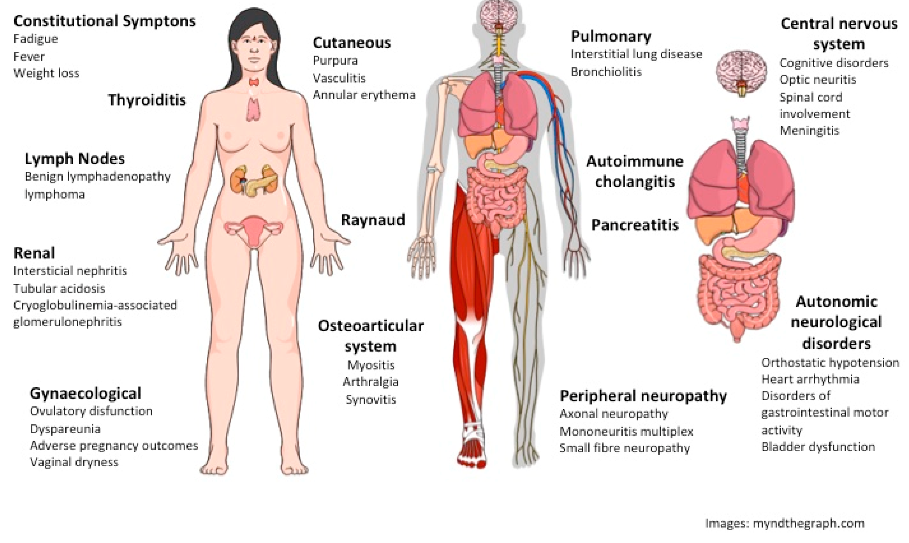 Image result for sjogren's syndrome