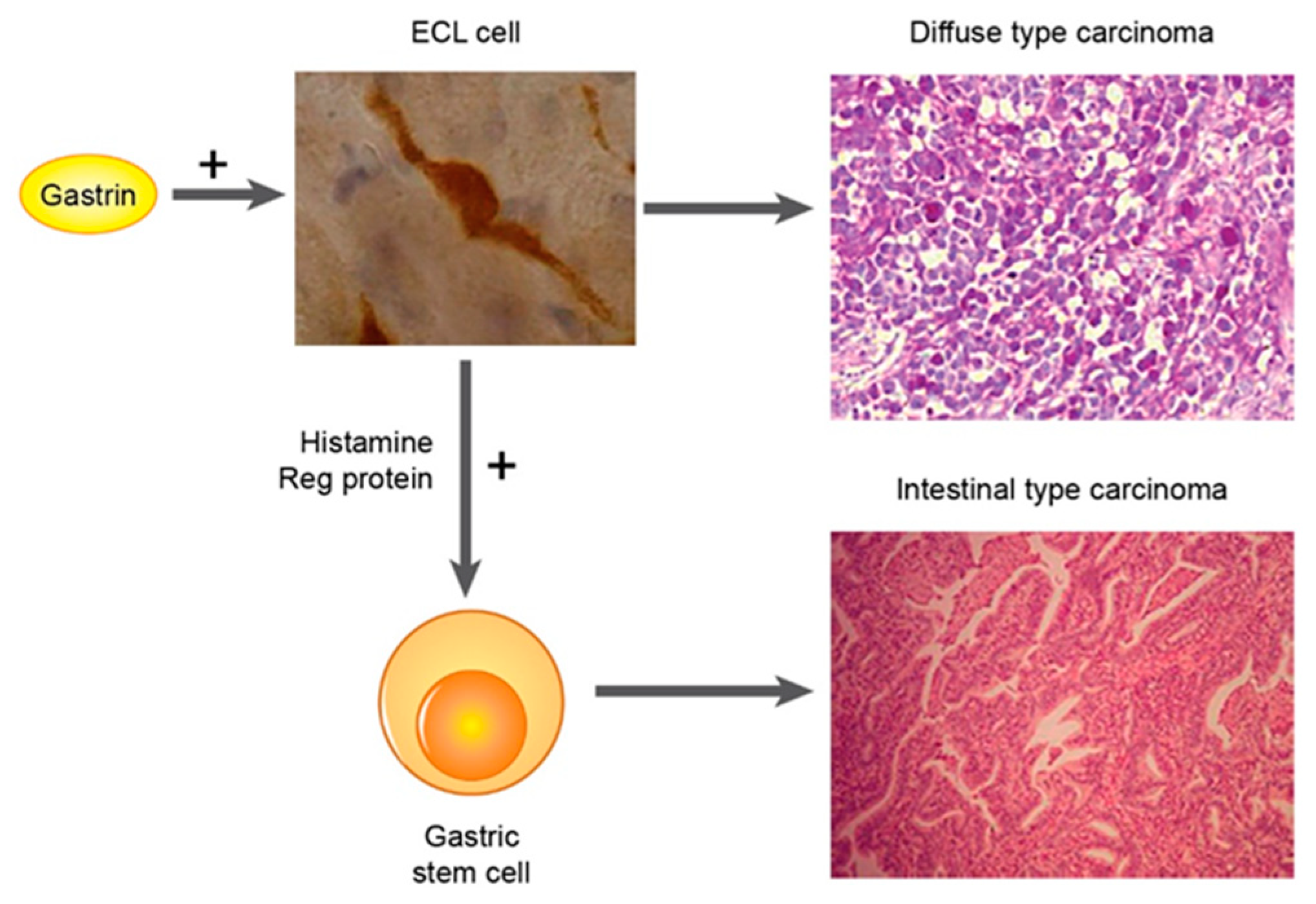 cancer gastric difuz