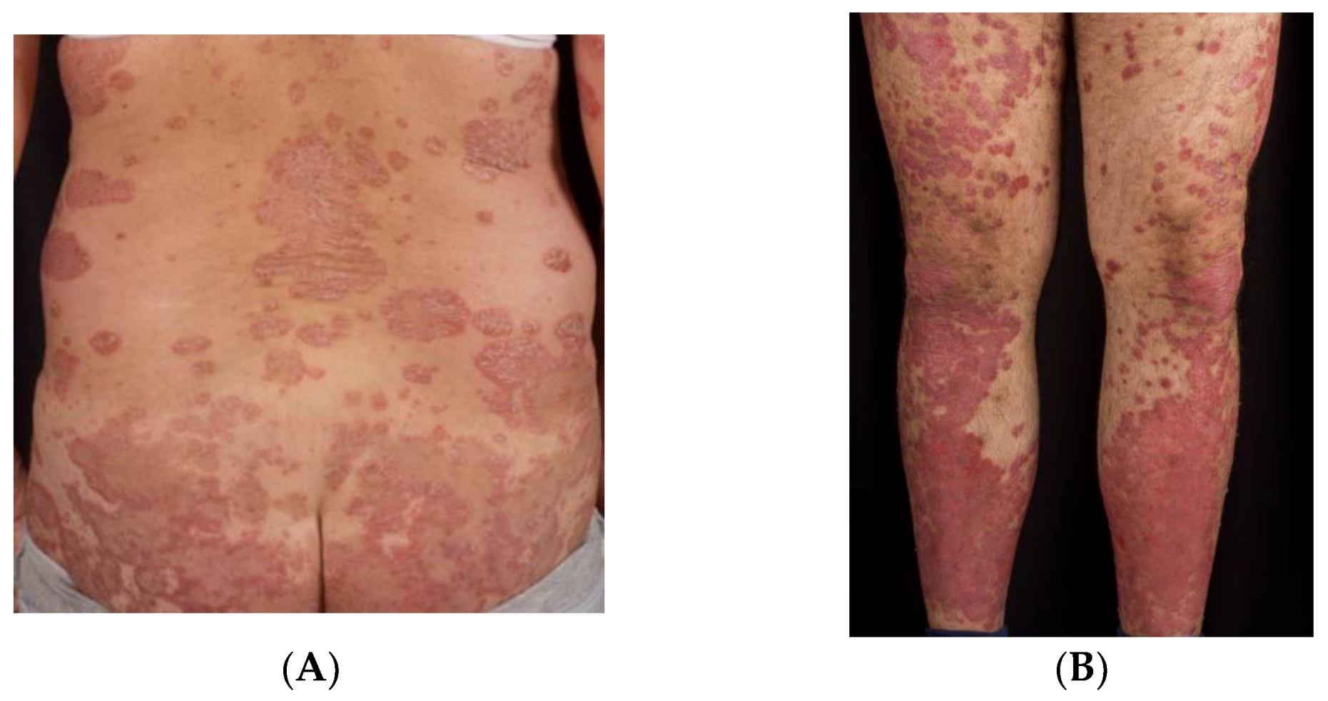 clinical presentation of inverse psoriasis)