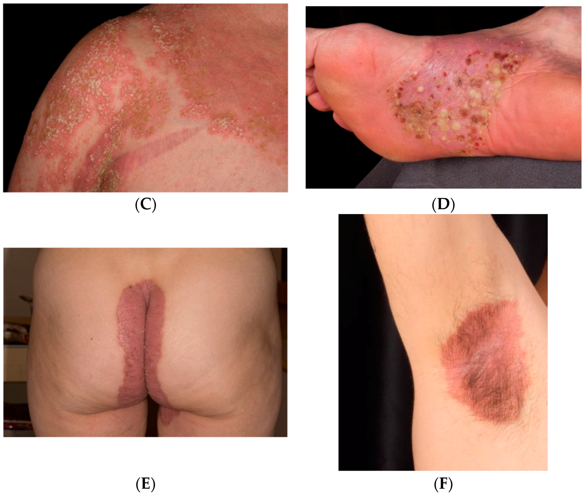 guttate psoriasis vs plaque psoriasis