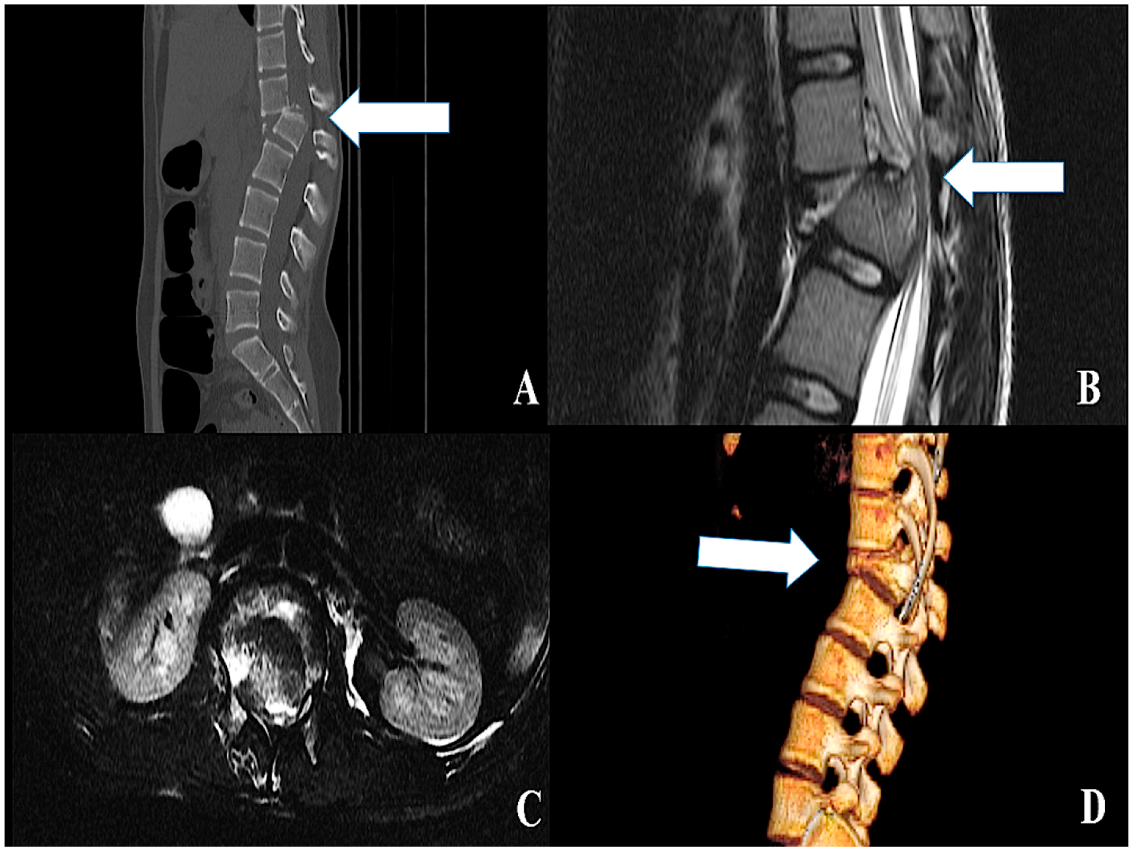 icd 10 code for neck pain with right arm radiculopathy