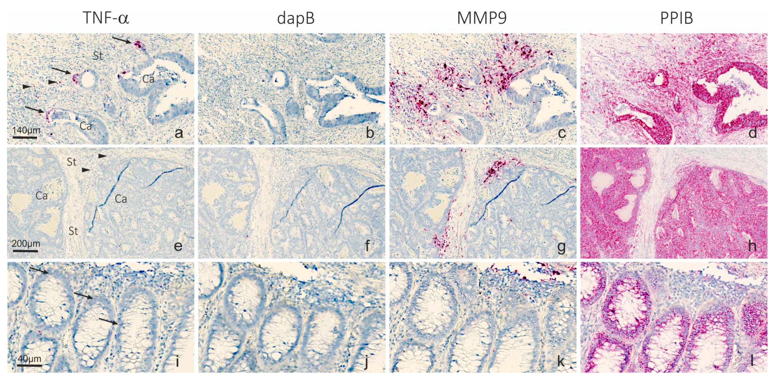 Co-Detection of miR-21 and TNF-α mRNA in Budding Cancer