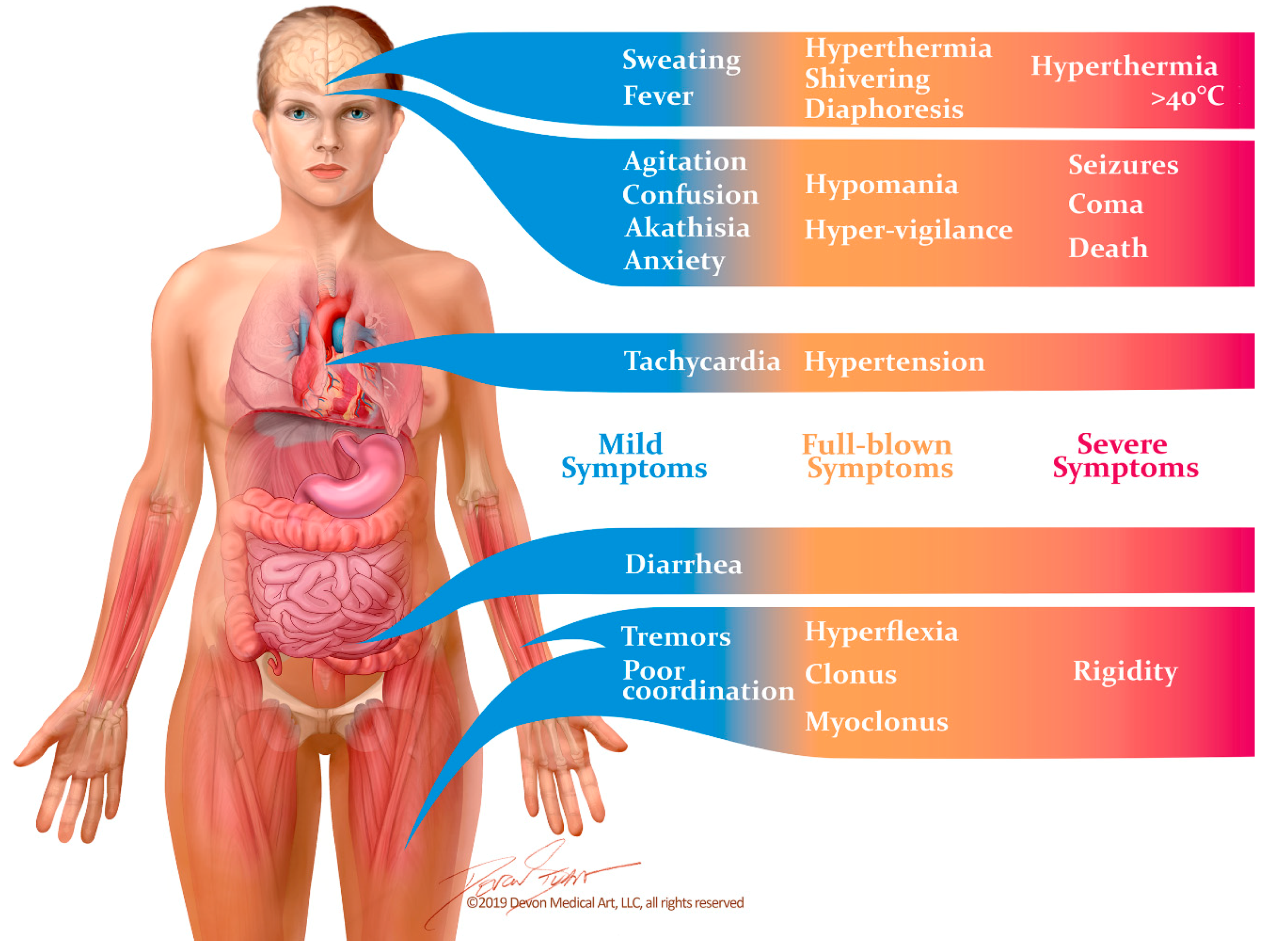 Serotoninový syndrom: příznaky, diagnostika a léčba