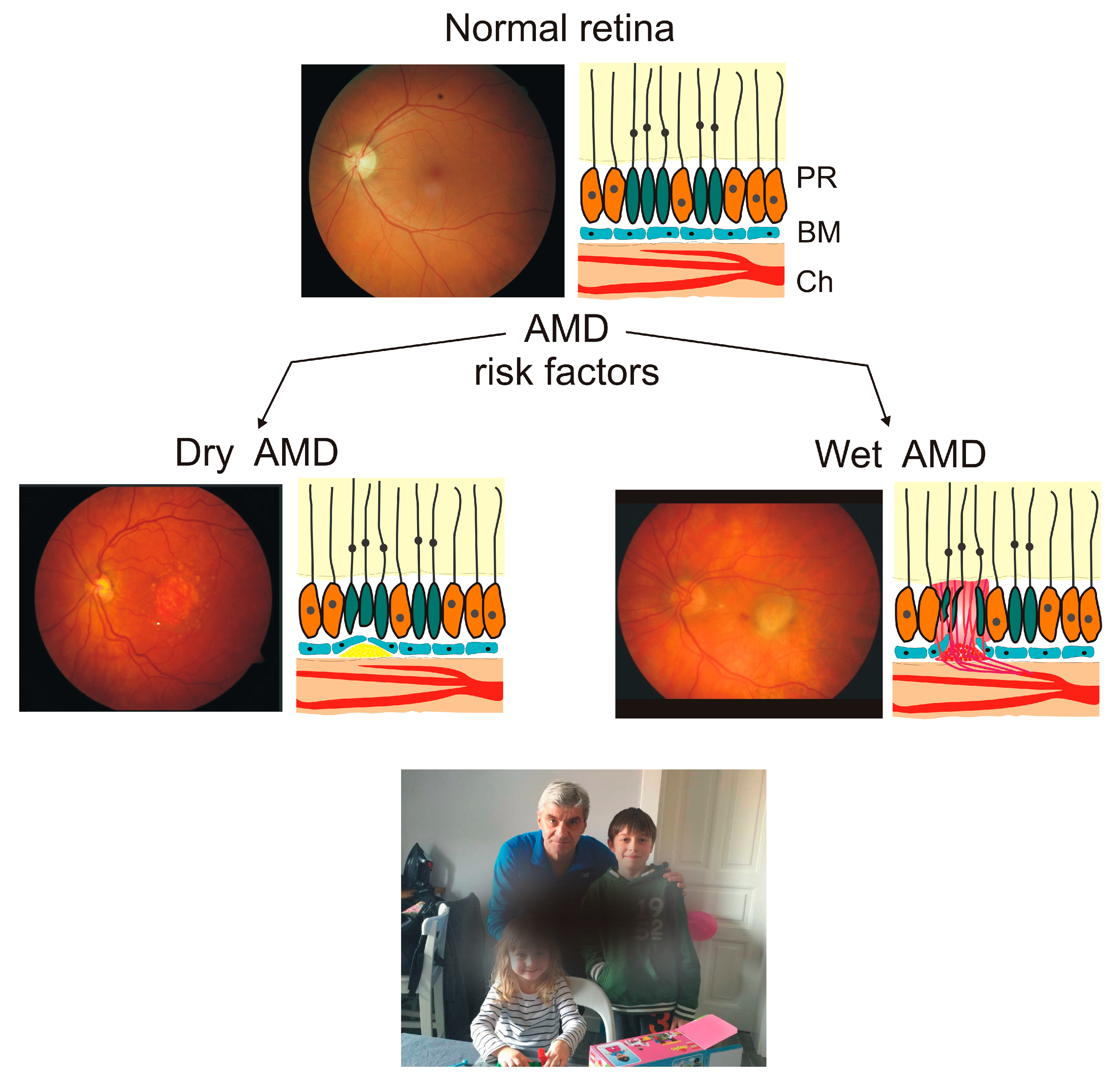 macular degeneration forum