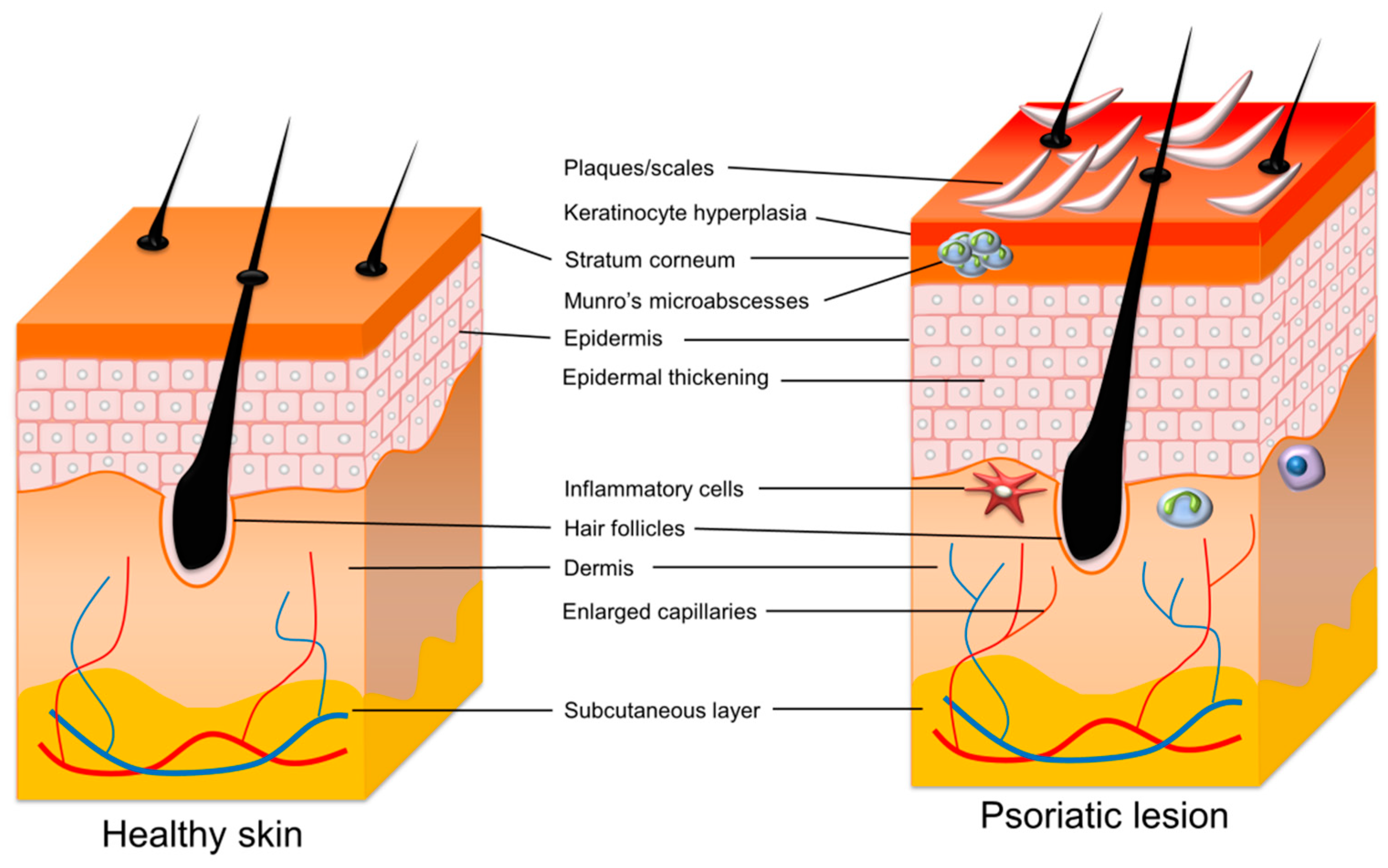 drug recen- rd for psoriasis reviews