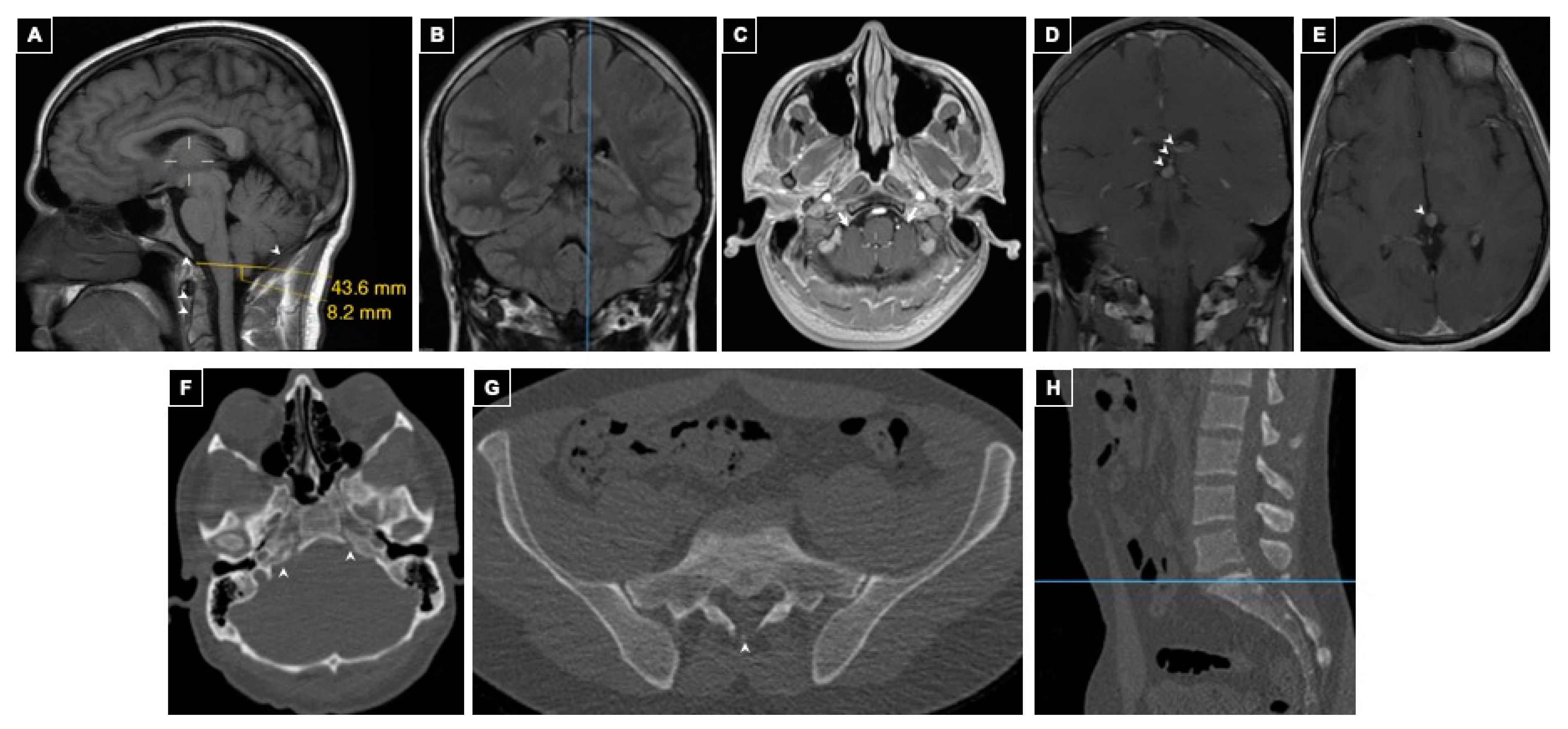 chiari malformation type 1 chiari malformation type 1