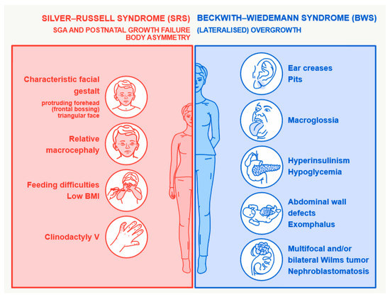 beckwith wiedemann syndrome adult