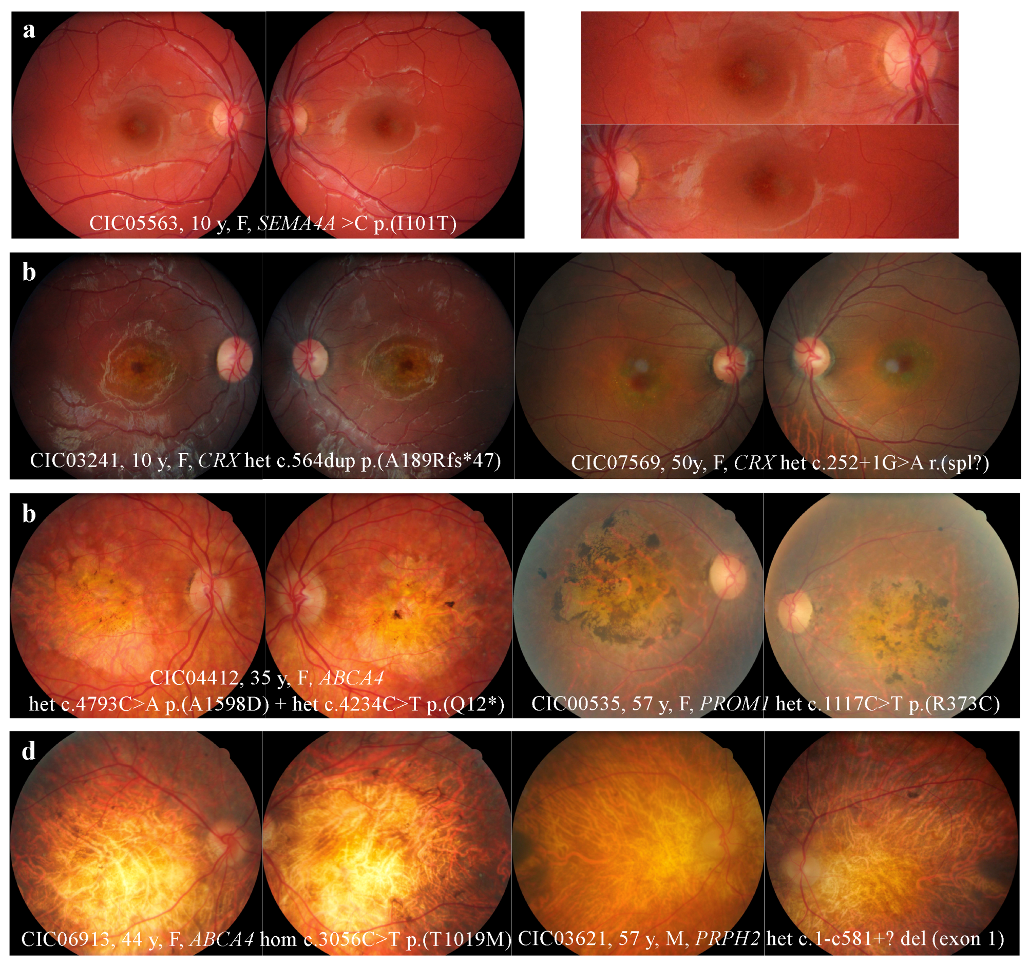 Ijms Free Full Text Phenotype Analysis Of Retinal Dystrophies In Light Of The Underlying Genetic Defects Application To Cone And Cone Rod Dystrophies Html