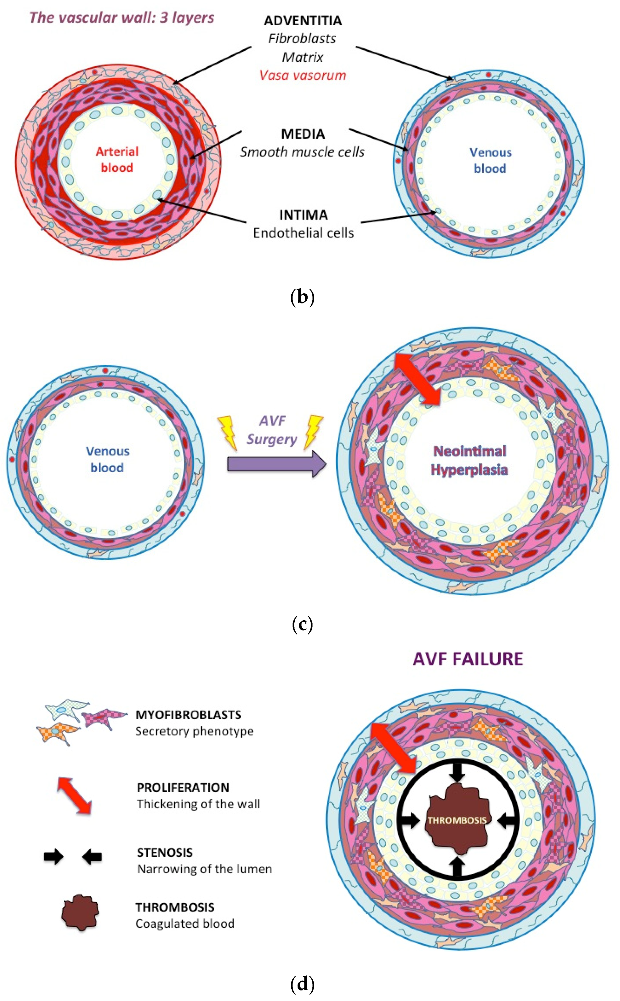 Ijms Free Full Text Role Of Hypoxia And Metabolism In The Development Of Neointimal Hyperplasia In Arteriovenous Fistulas Html