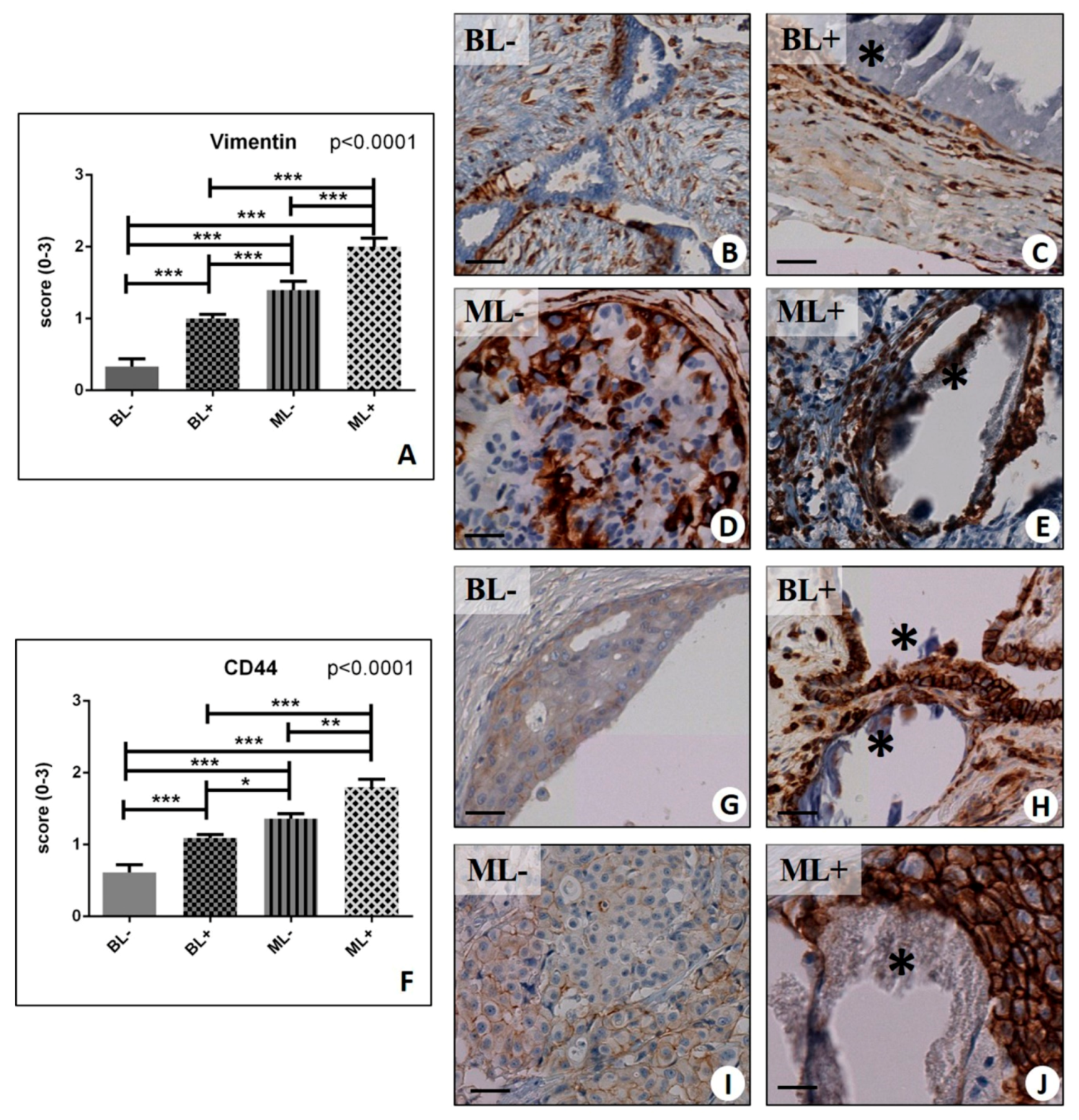 Ijms Free Full Text Microcalcifications Drive Breast Cancer Occurrence And Development By Macrophage Mediated Epithelial To Mesenchymal Transition Html Ijms Free Full Text Microcalcifications Drive Breast Cancer Occurrence And Development By Macrophage Mediated Epithelial To Mesenchymal Transition Html