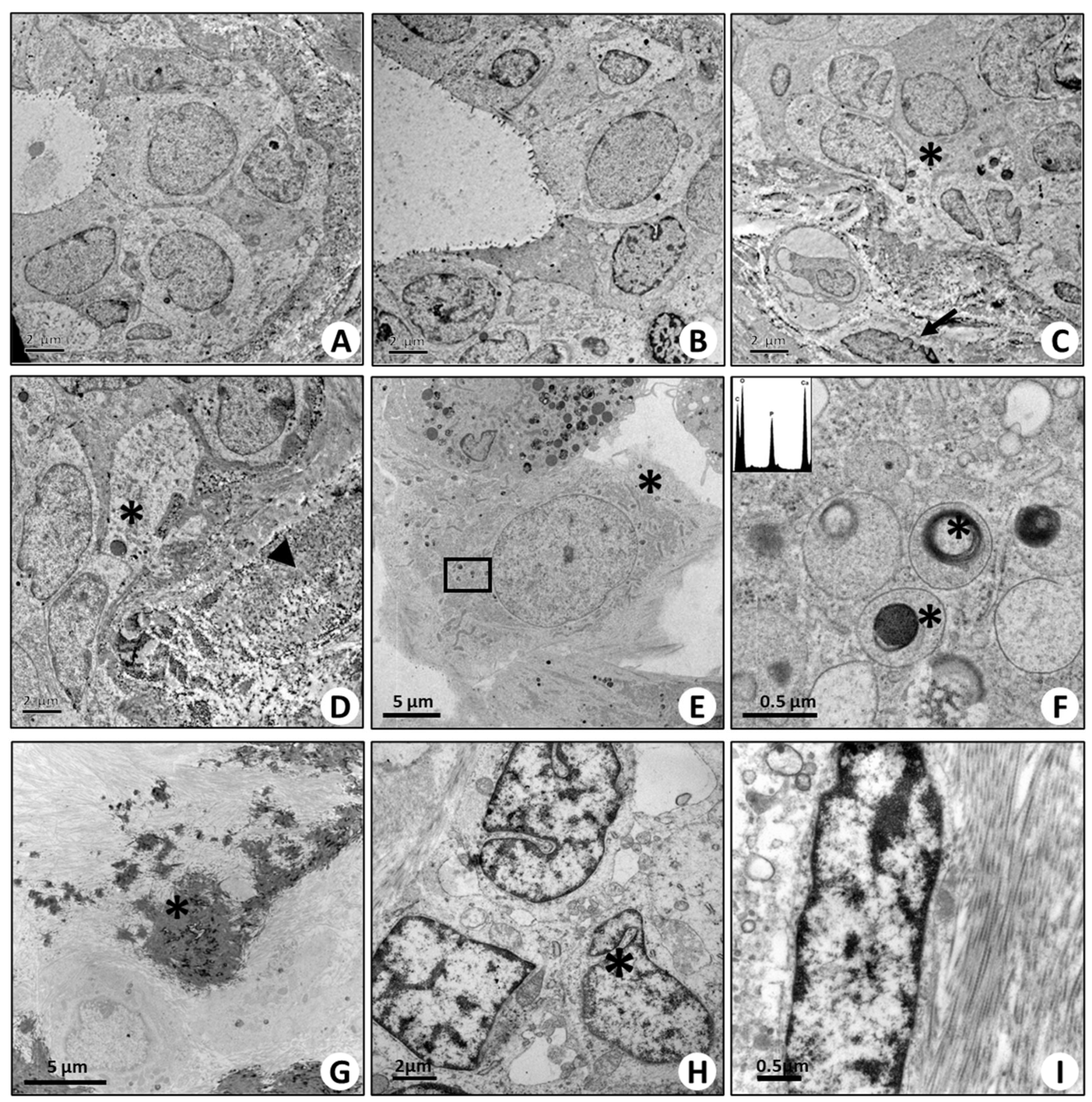Ijms Free Full Text Microcalcifications Drive Breast Cancer Occurrence And Development By Macrophage Mediated Epithelial To Mesenchymal Transition Html Ijms Free Full Text Microcalcifications Drive Breast Cancer Occurrence And Development By Macrophage Mediated Epithelial To Mesenchymal Transition Html