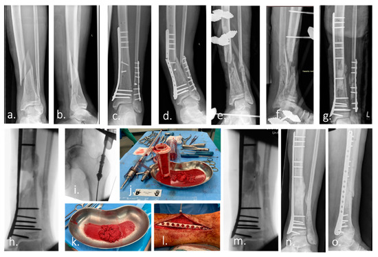 Self-powered implantable device stimulates fast bone healing, then