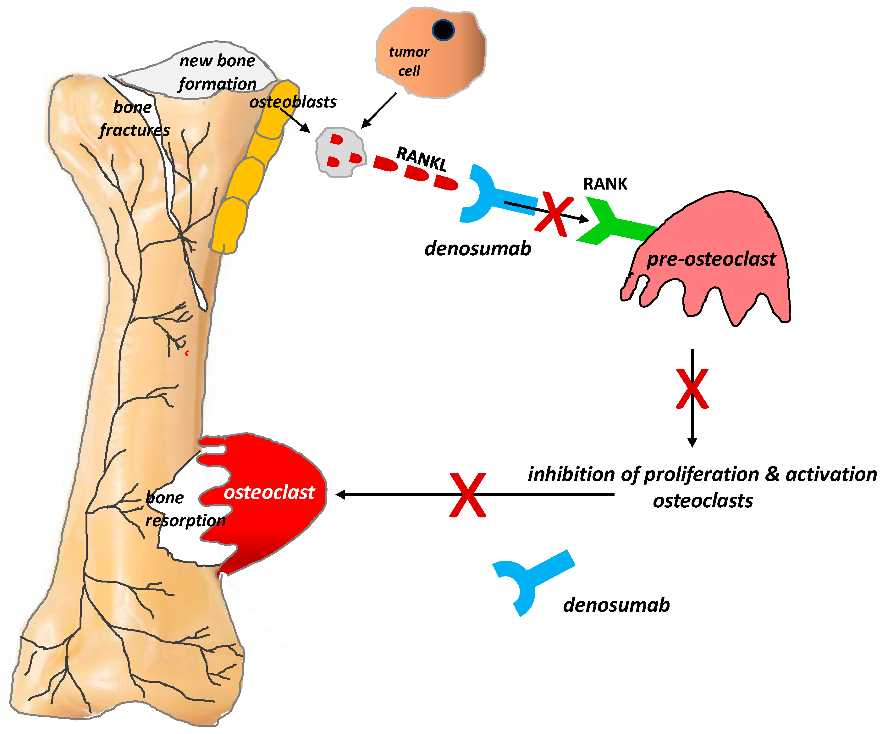 Ijms | Free Full-Text | Bone Pain In Cancer Patients: Mechanisms And  Current Treatment | Html