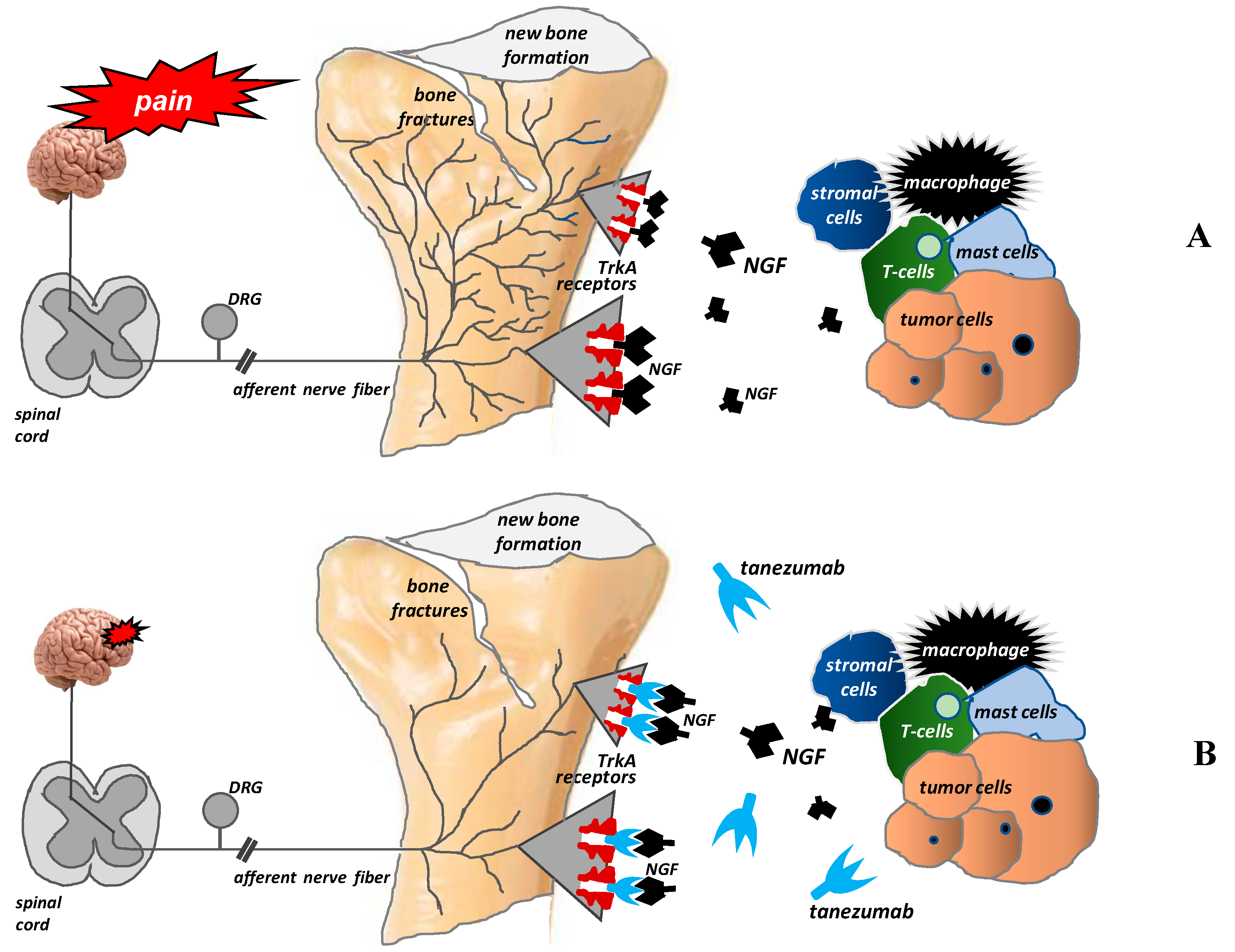 IJMS Free FullText Bone Pain in Cancer Patients Mechanisms and