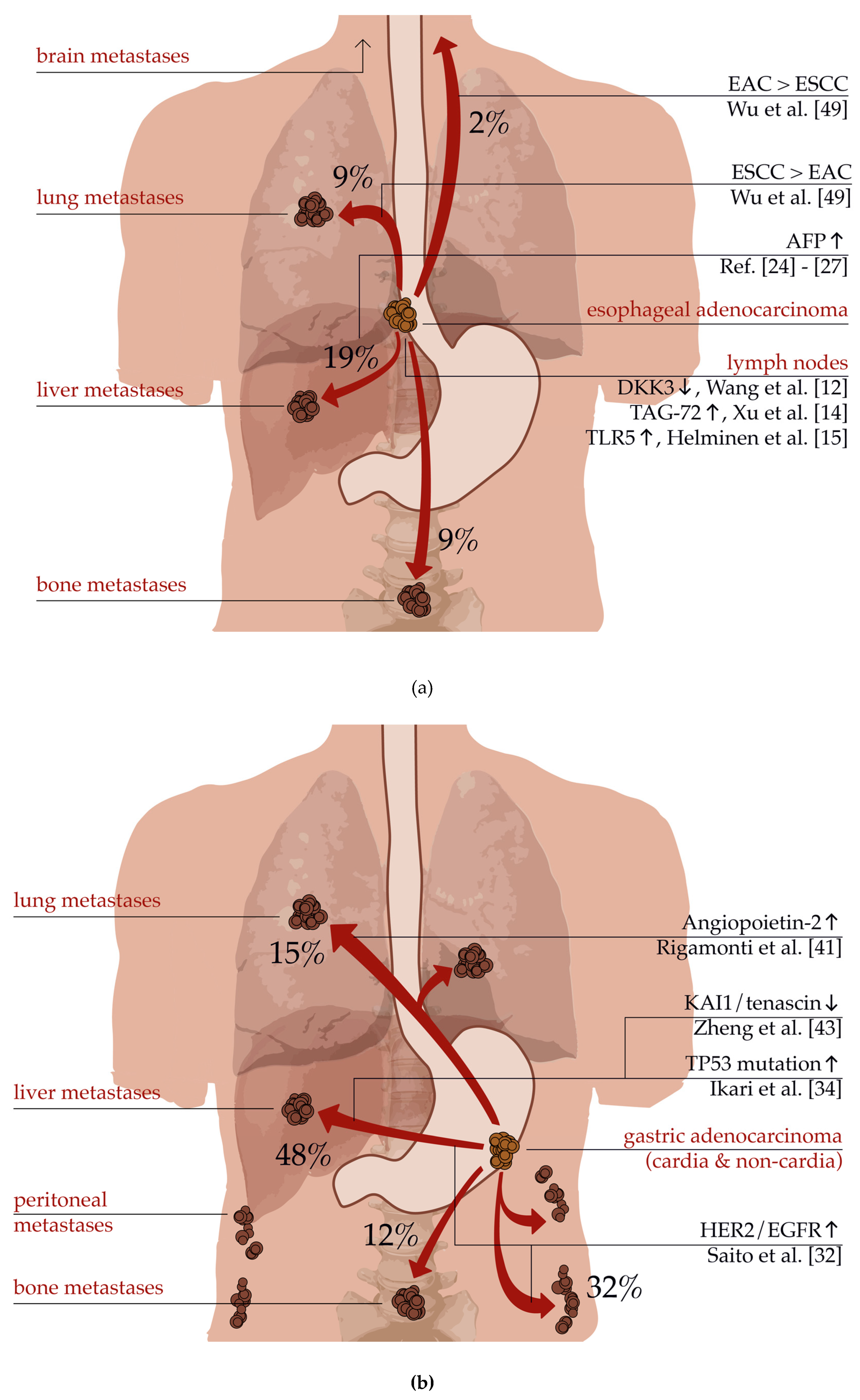 Oligometastatic Gastroesophageal Adenocarcinoma: Molecular