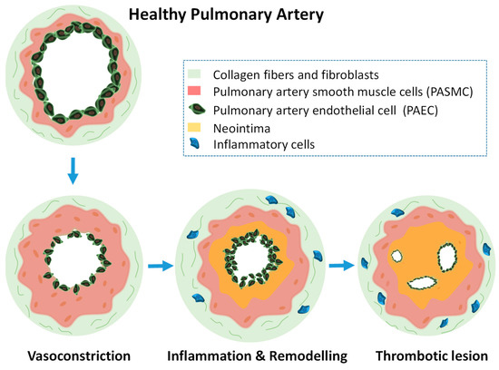 how does metastatic bone cancer kill you