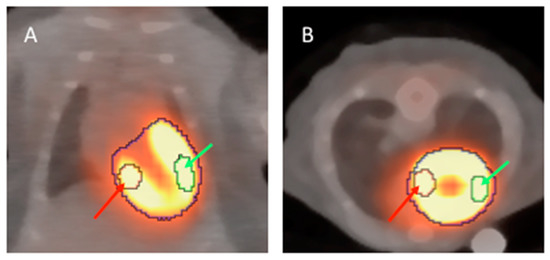 18F-FDG PET-Based Imaging of Myocardial Inflammation Following Acute ...
