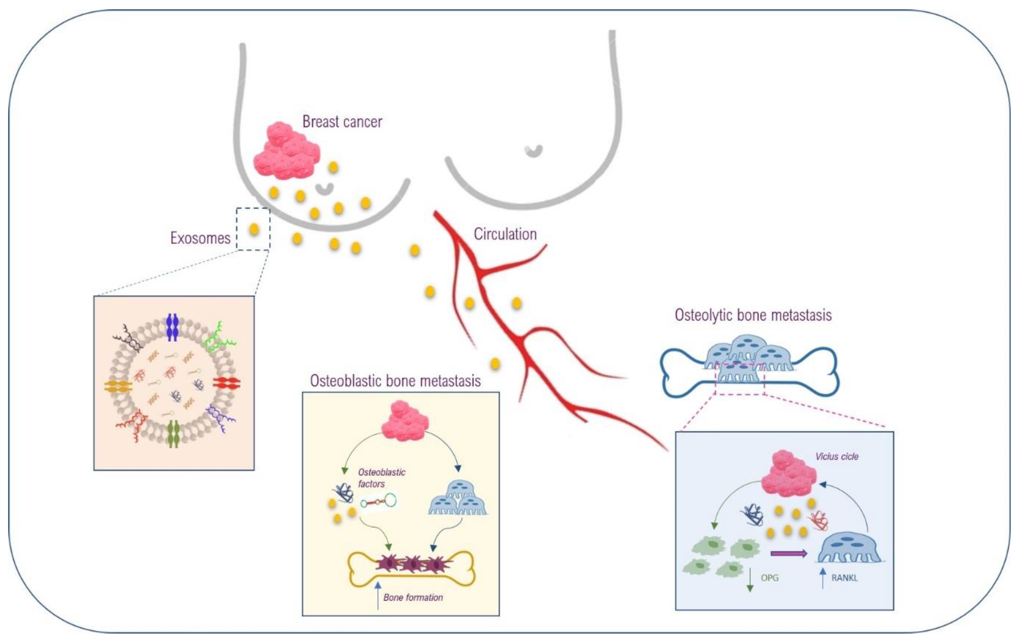 【ラッピング不可】 Breast Cancer Derived Extracellular Vesicles in Bone 臨床医学