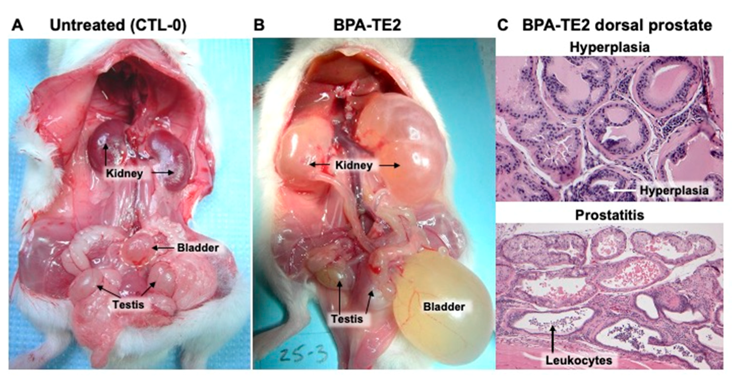 prostatitis ül