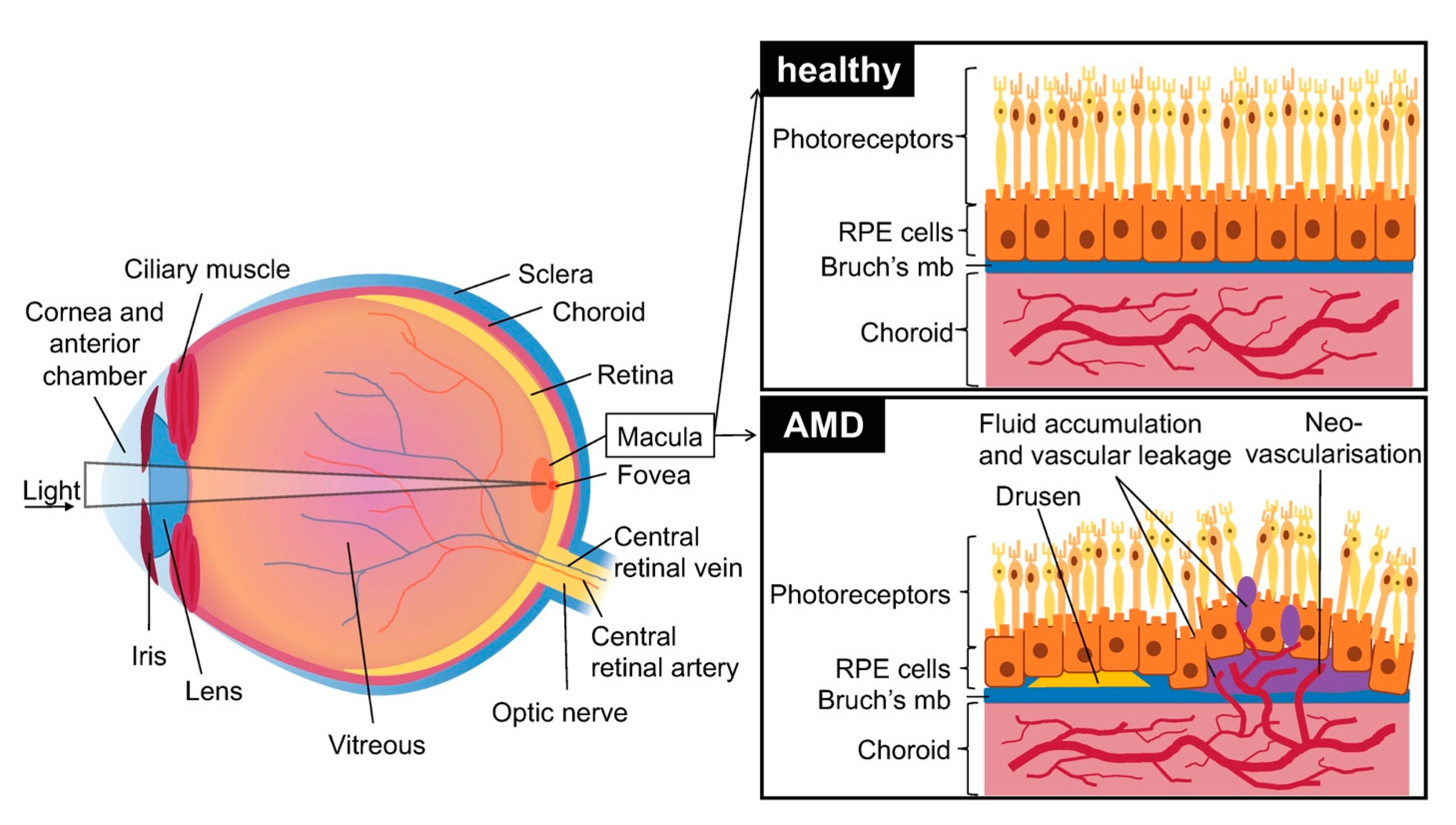 Common Concerns: Macular Degeneration