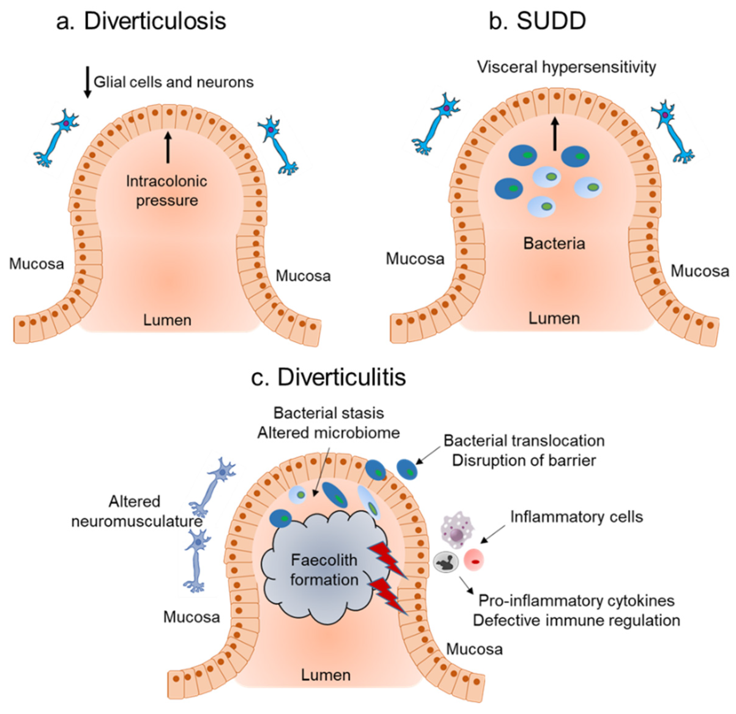 Inflammatory Bowel Disease Diverticulitis  Captions Lovely