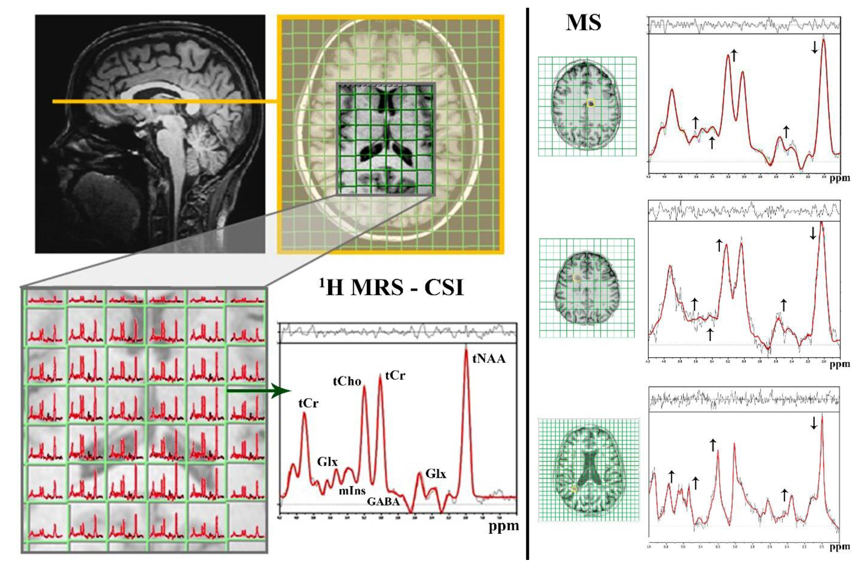 Ijms Free Full Text Current Methods Of Magnetic Resonance For Noninvasive Assessment Of Molecular Aspects Of Pathoetiology In Multiple Sclerosis Html Ijms Free Full Text Current Methods Of Magnetic Resonance For Noninvasive Assessment Of Molecular Aspects Of Pathoetiology In Multiple Sclerosis Html