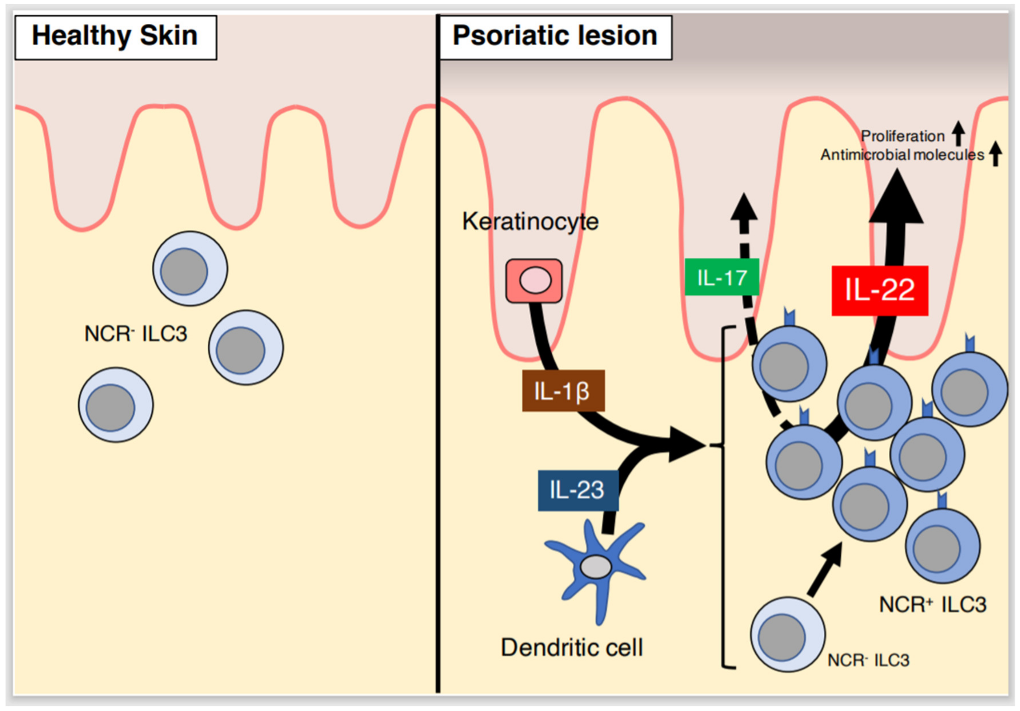 Ijms Free Full Text Role Of Innate Immune Cells In Psoriasis Html