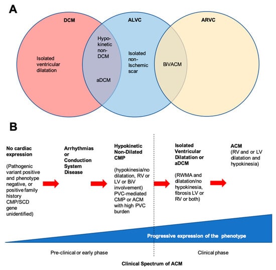 Left Ventricular Dysfunction in Arrhythmogenic Cardiomyopathy: Association  With Exercise Exposure, Genetic Basis, and Prognosis