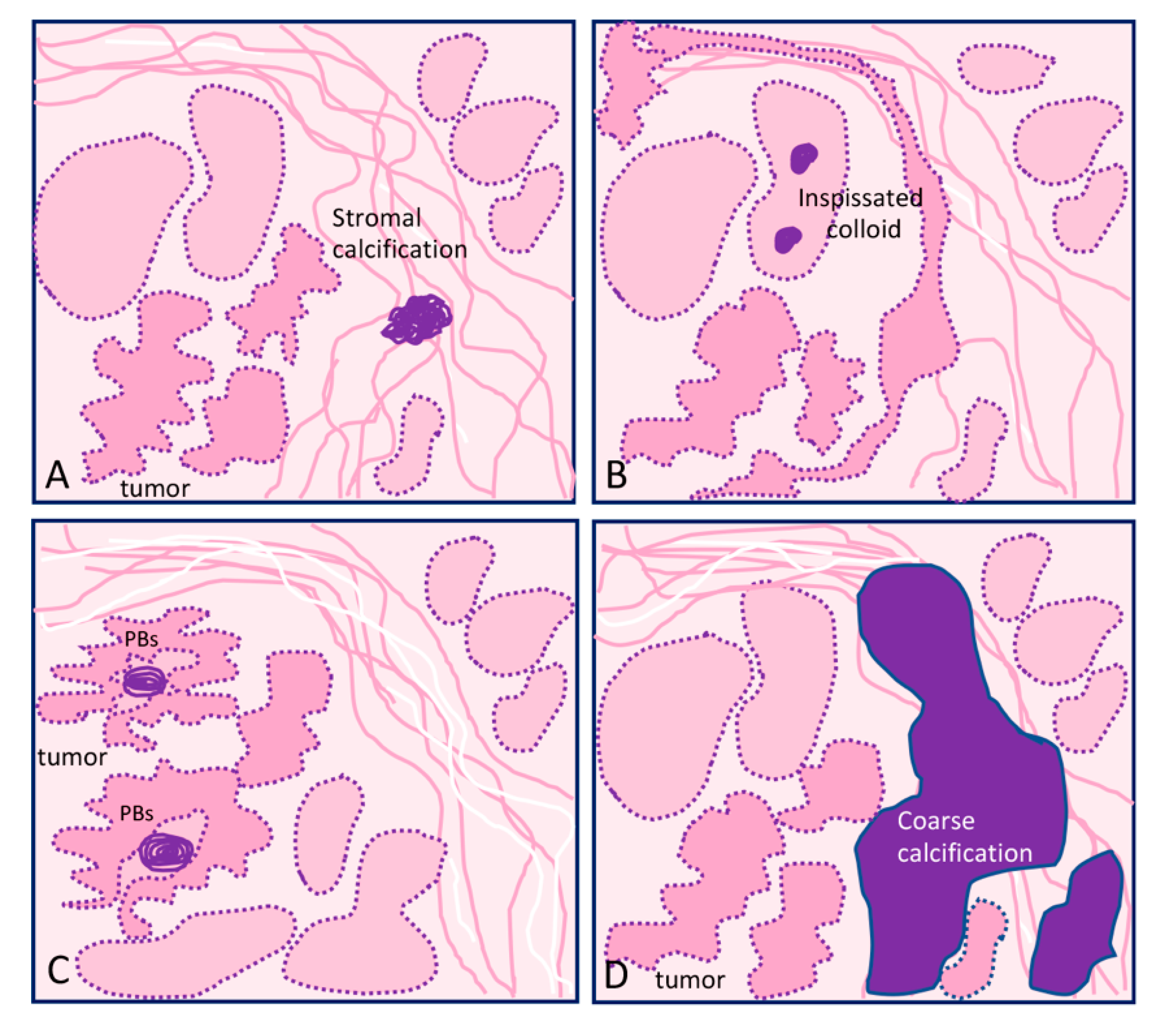 IJMS | Free Full-Text | Molecular Aspects of Thyroid Calcification