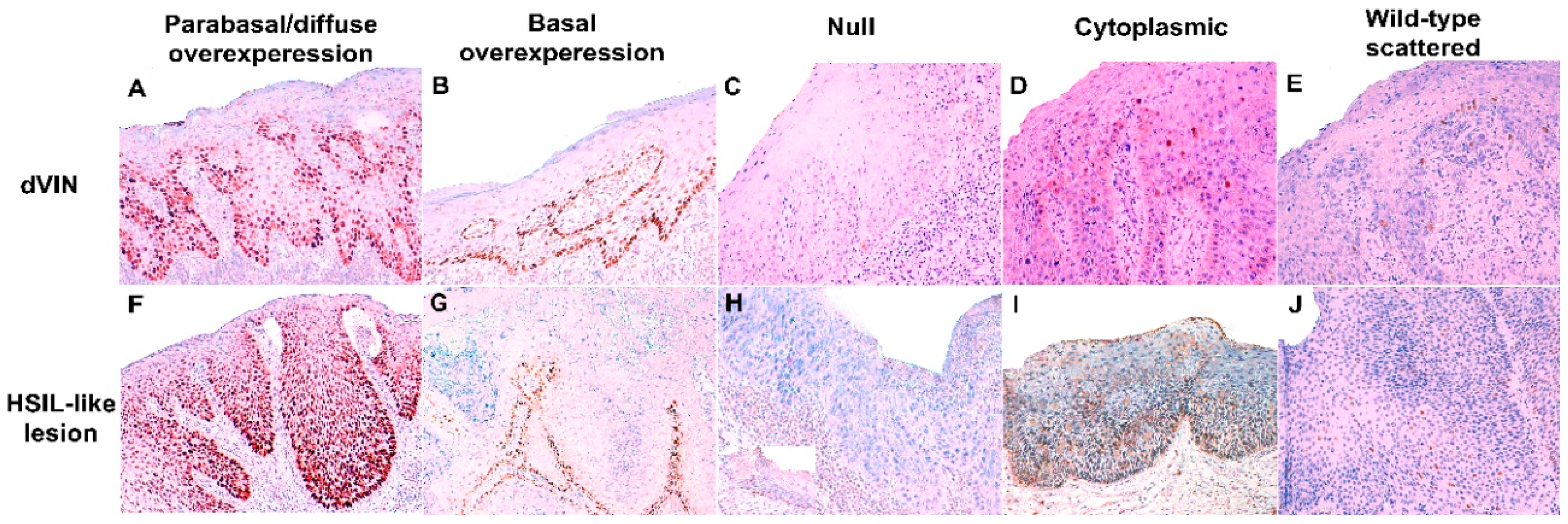 IJMS | Free Full-Text | p53 Immunohistochemical Patterns in HPV-Independent  Squamous Cell Carcinomas of the Vulva and the Associated Skin Lesions: A  Study of 779 Cases