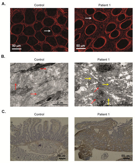 Enhanced Collagen Deposition in the Duodenum of Patients with