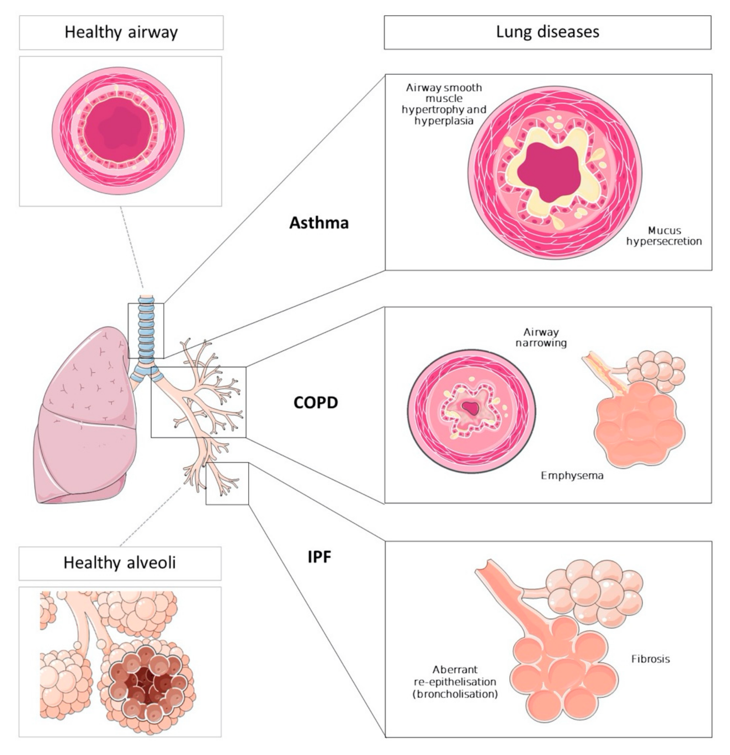 IJMS | Free Full-Text | Vesicles from Airway Secretions: New Insights in Lung Diseases | HTML