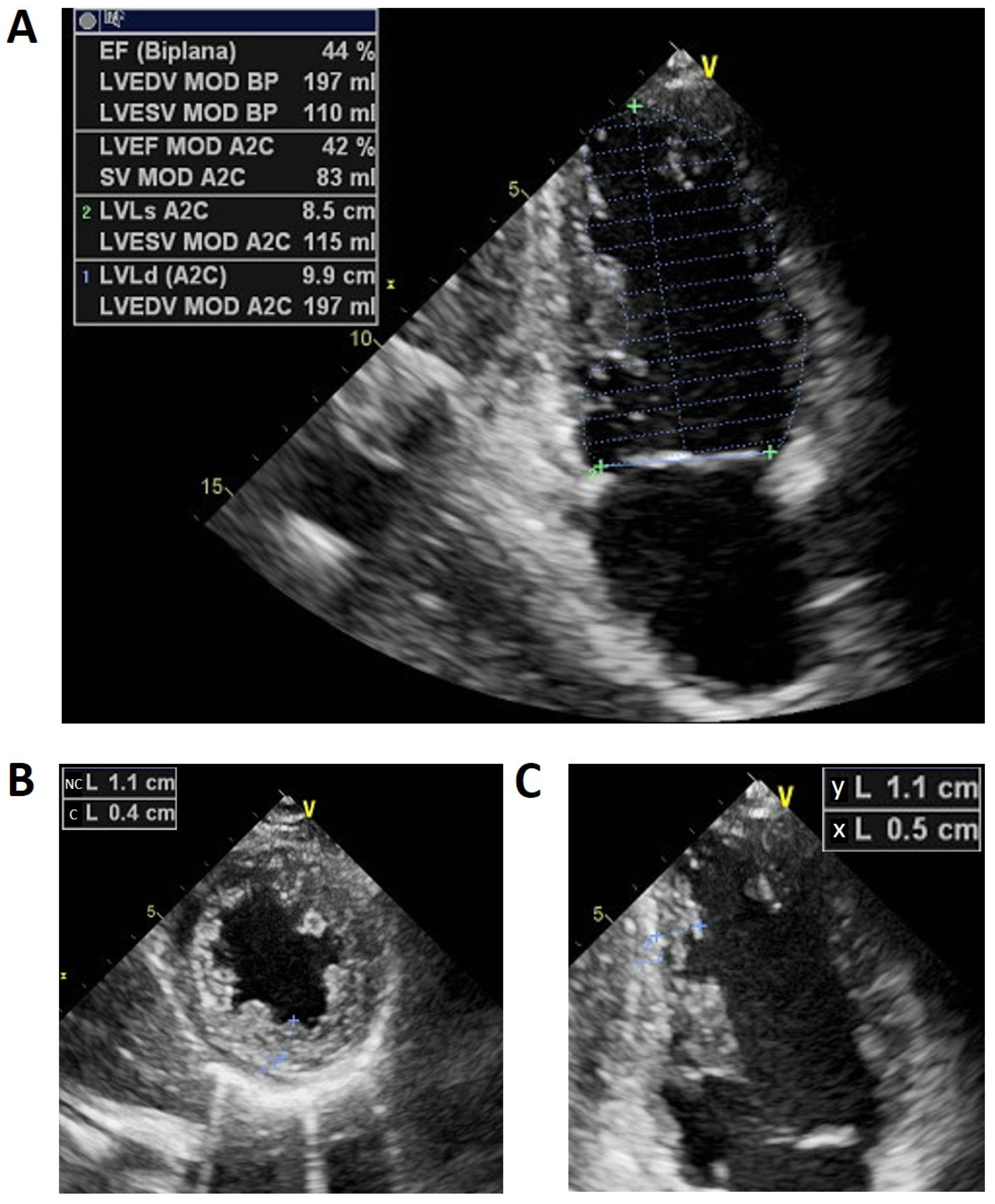 Ijms Free Full Text Clinical Considerations For A Family With Dilated Cardiomyopathy Sudden Cardiac Death And A Novel Ttn Frameshift Mutation Html
