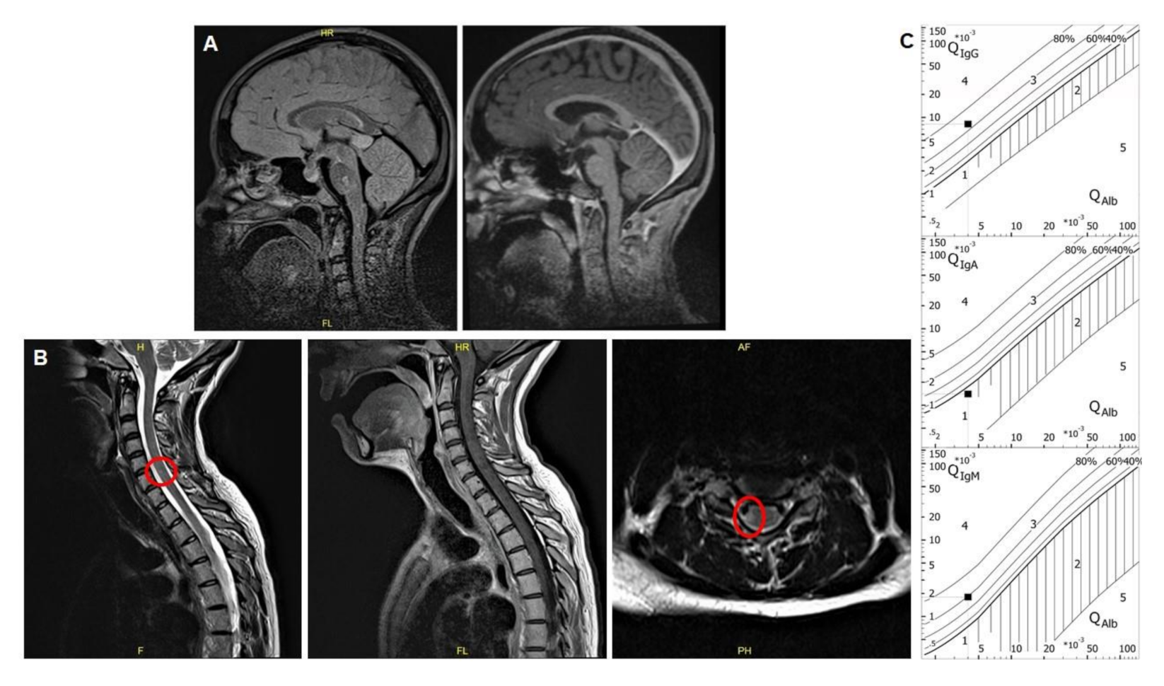 Spinal cord involvement and paroxysmal events in “Infantile