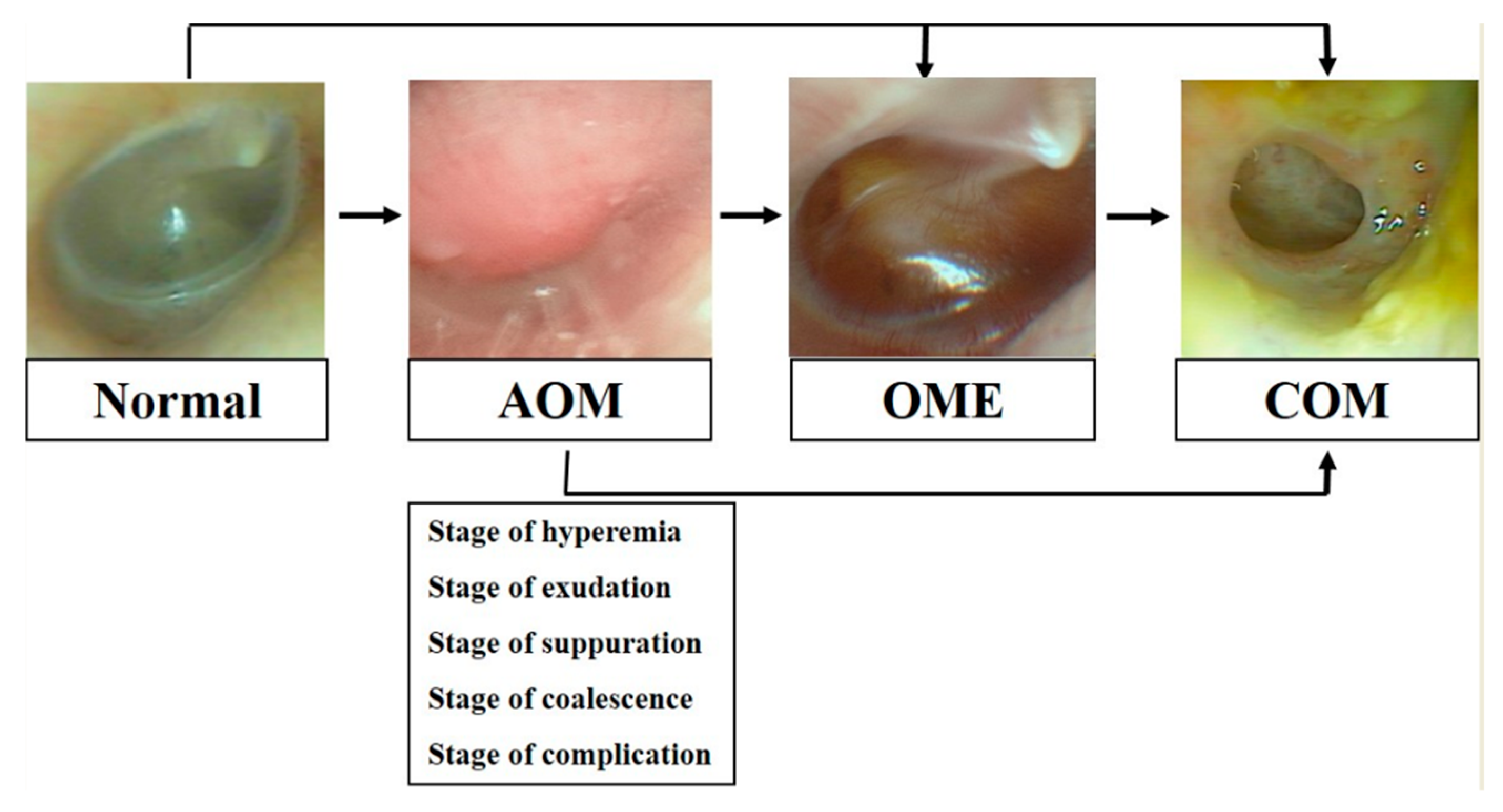 otitis media