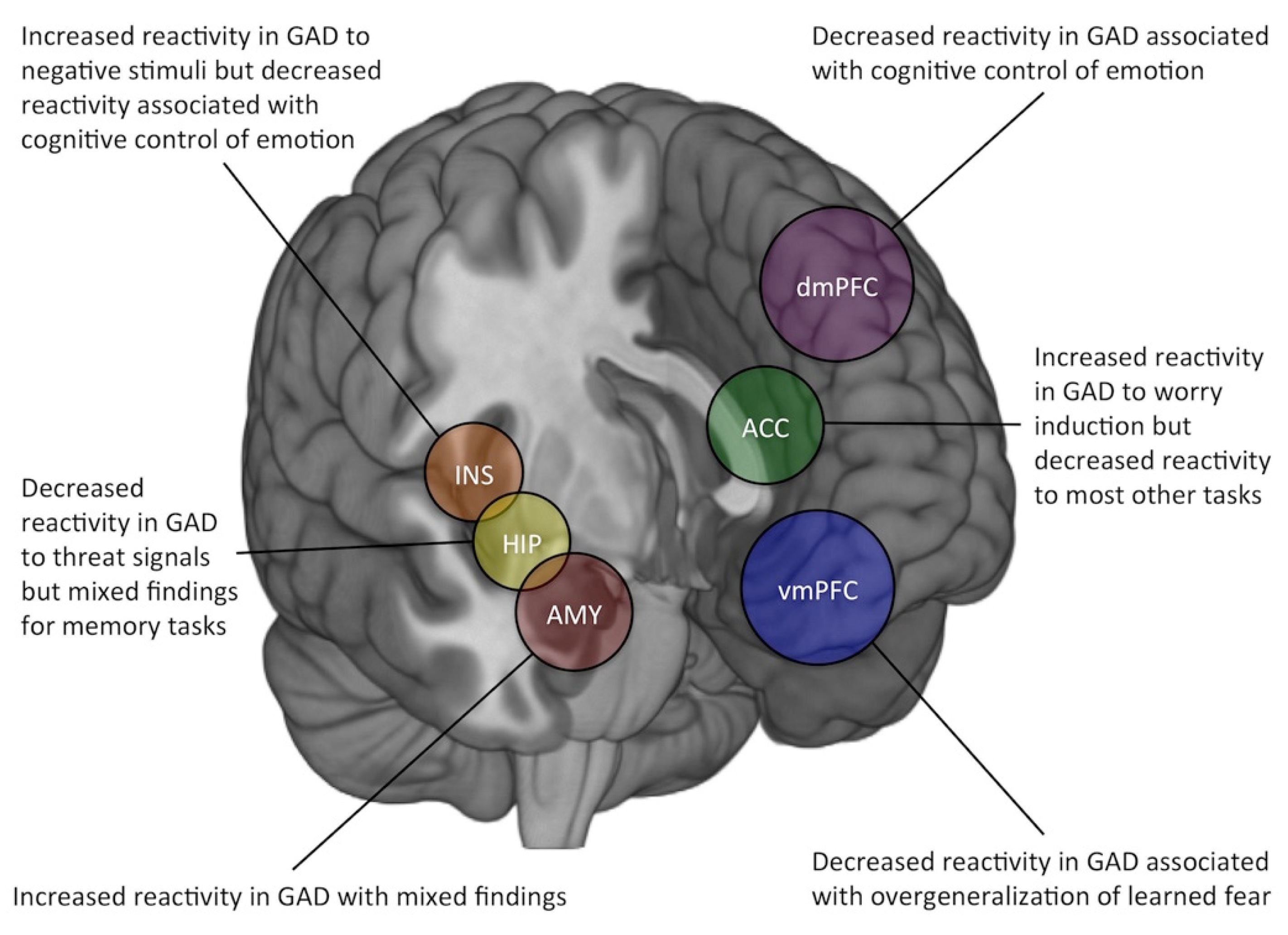 anxiety disorder brain