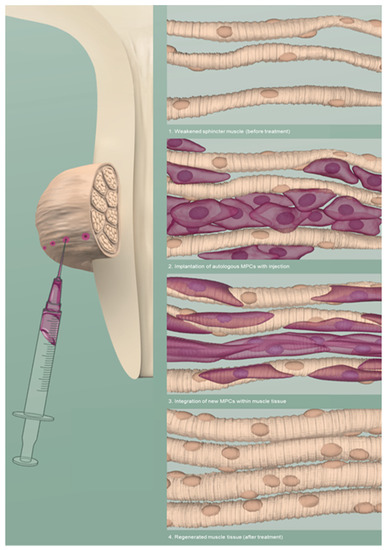 Treatment of Stress Urinary Incontinence with Muscle Stem Cells and ...