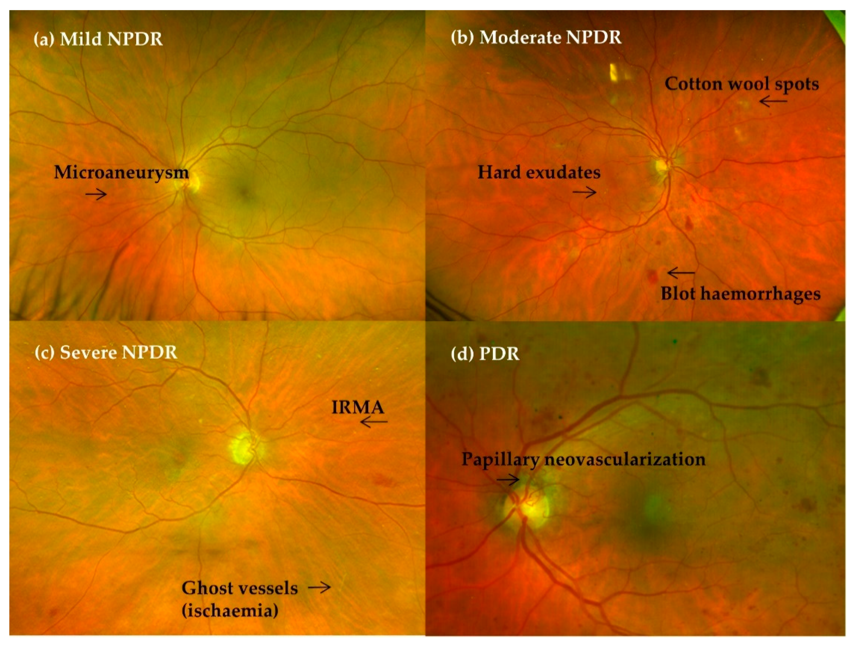 diabetic retinopathy bmj best practice