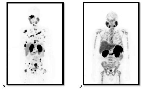 cns és prostatitis