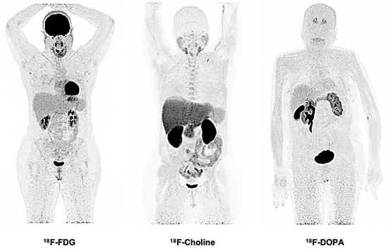 健康・医学 PET in Clinical Oncology PET and PET/CT: A Clinical Guide: 9781604061536: Medicine