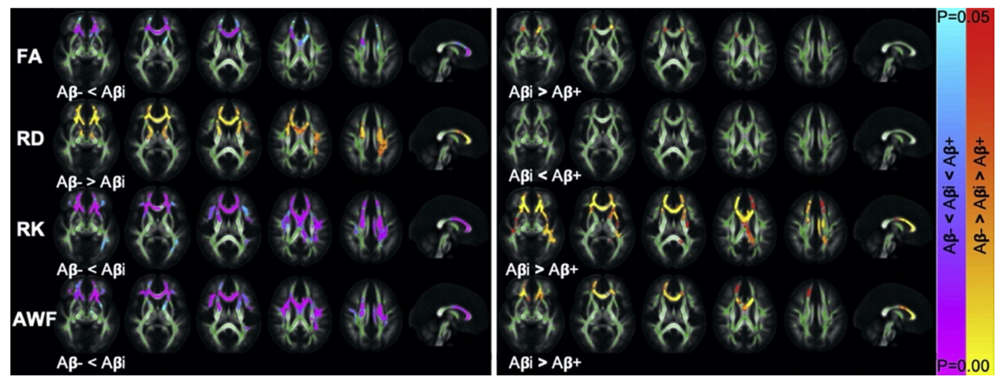 Ijms Free Full Text Diffusion Magnetic Resonance Imaging Based Biomarkers For Neurodegenerative Diseases Html