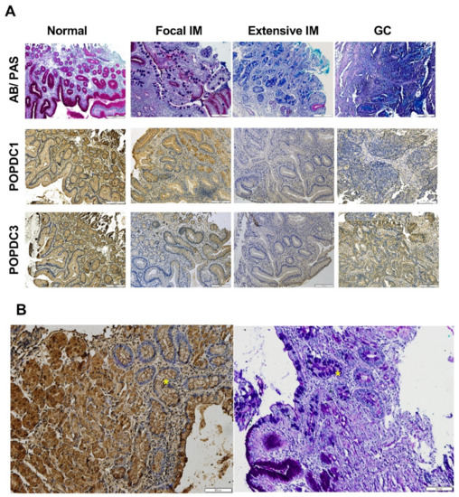 The Transition from Gastric Intestinal Metaplasia to Gastric Cancer ...