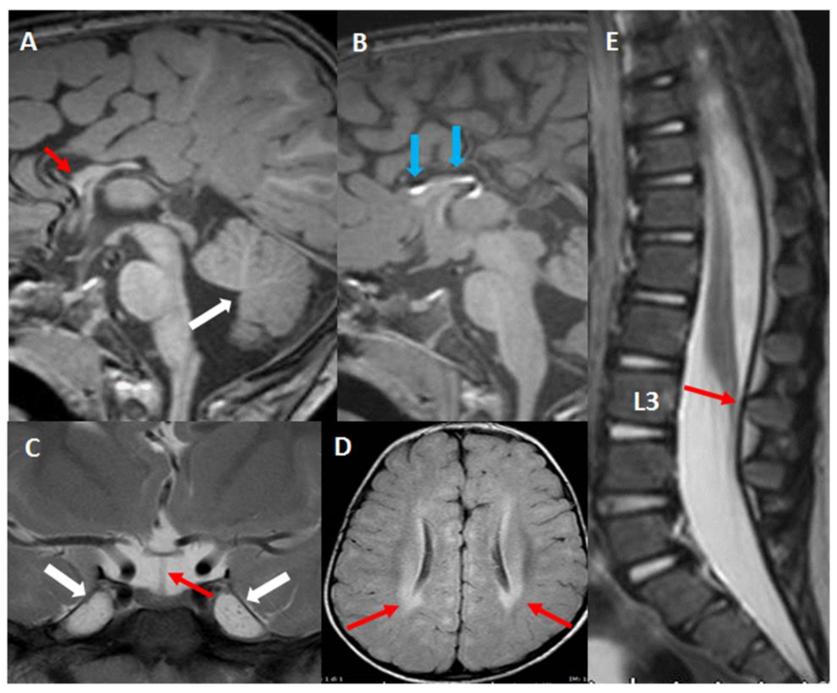 Clinical and mutational spectrum in Korean patients with Rubinstein–Taybi  syndrome: The spectrum of brain MRI abnormalities - ScienceDirect