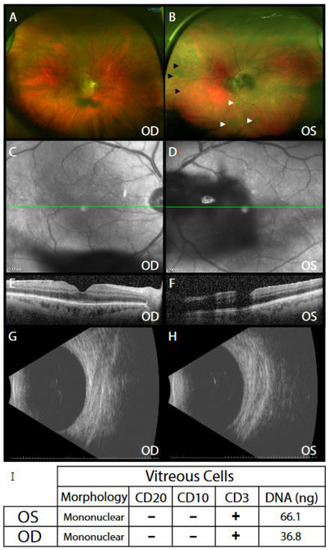 健康・医学 Vitreous Microsurgery Vitreous Microsurgery: 9781975168353: Medicine & Health