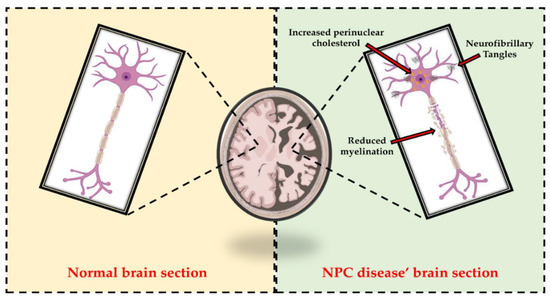 The pathogenesis of Niemann–Pick type C disease: a role for