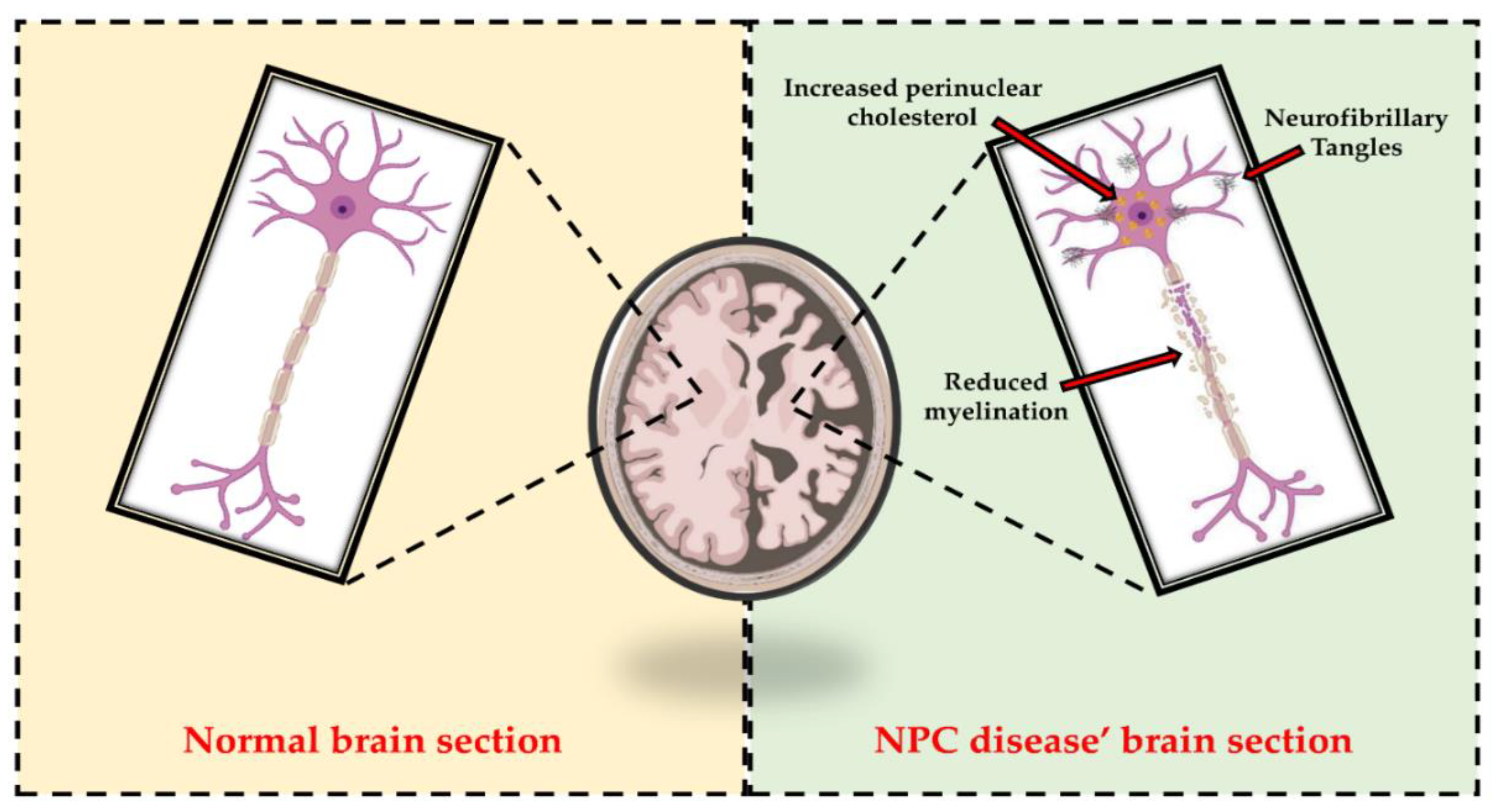 Niemann-Pick disease Information