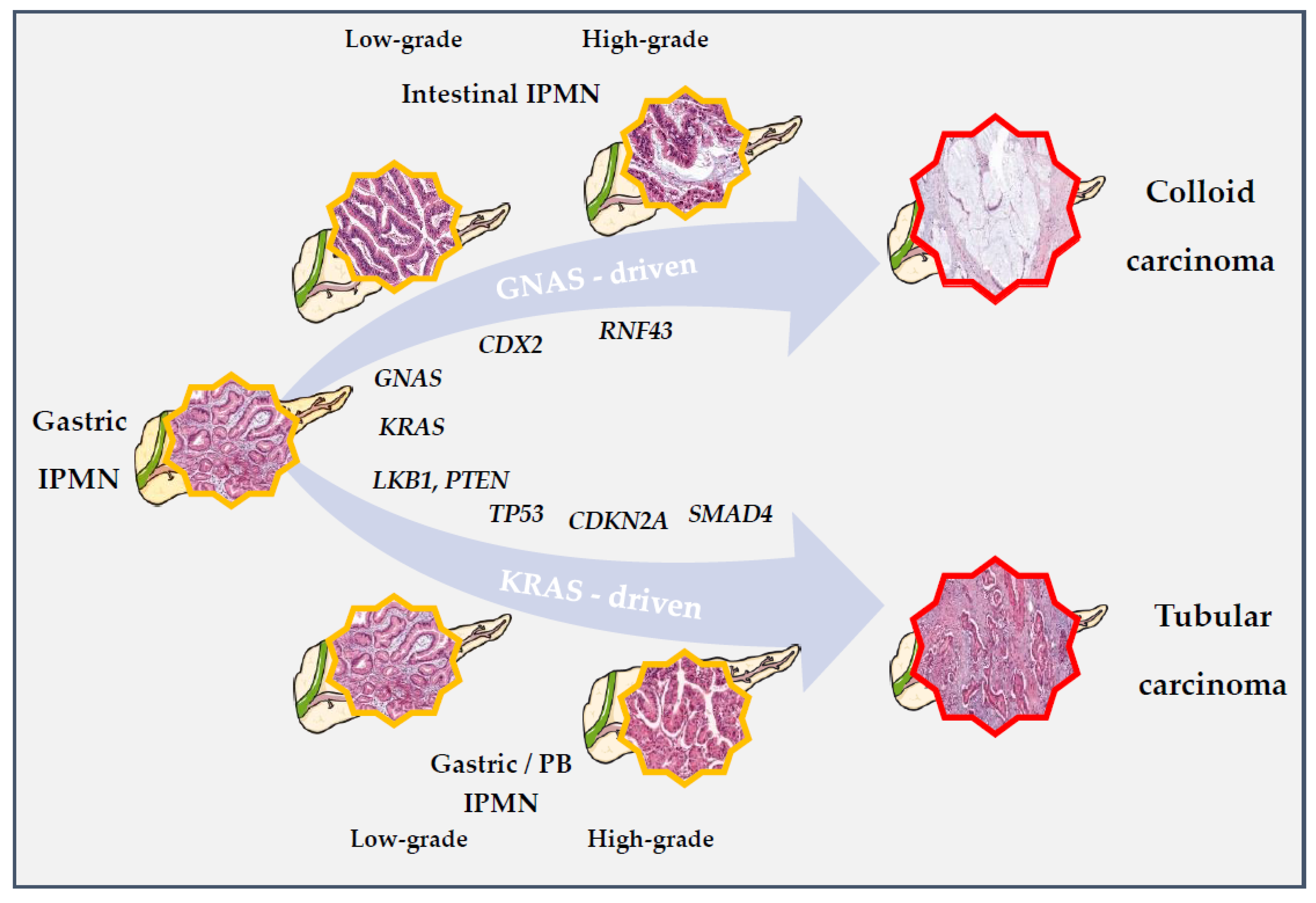 Intraductal Papillary Mucinous Carcinoma Versus Conventional